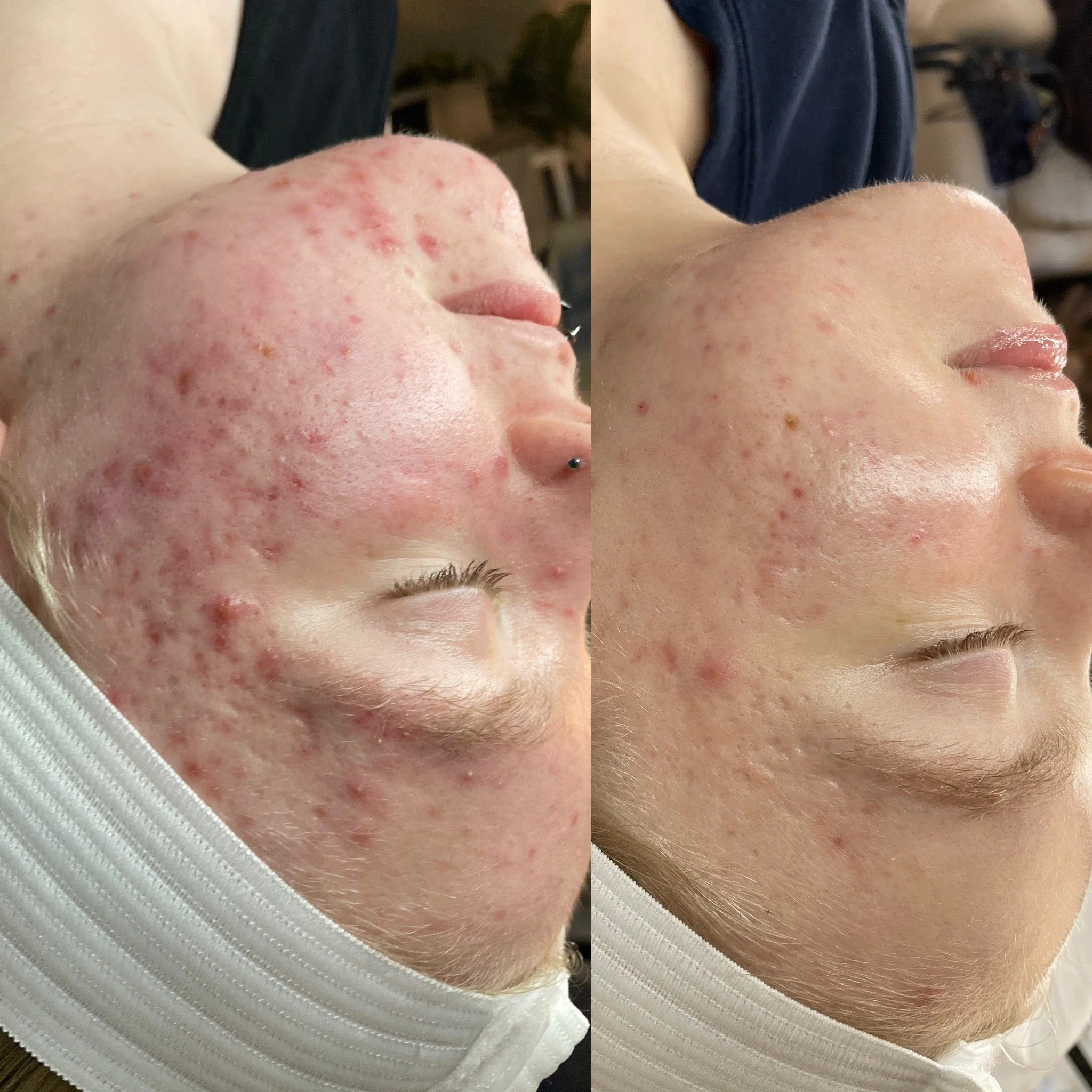 chemical peel results Kansas City