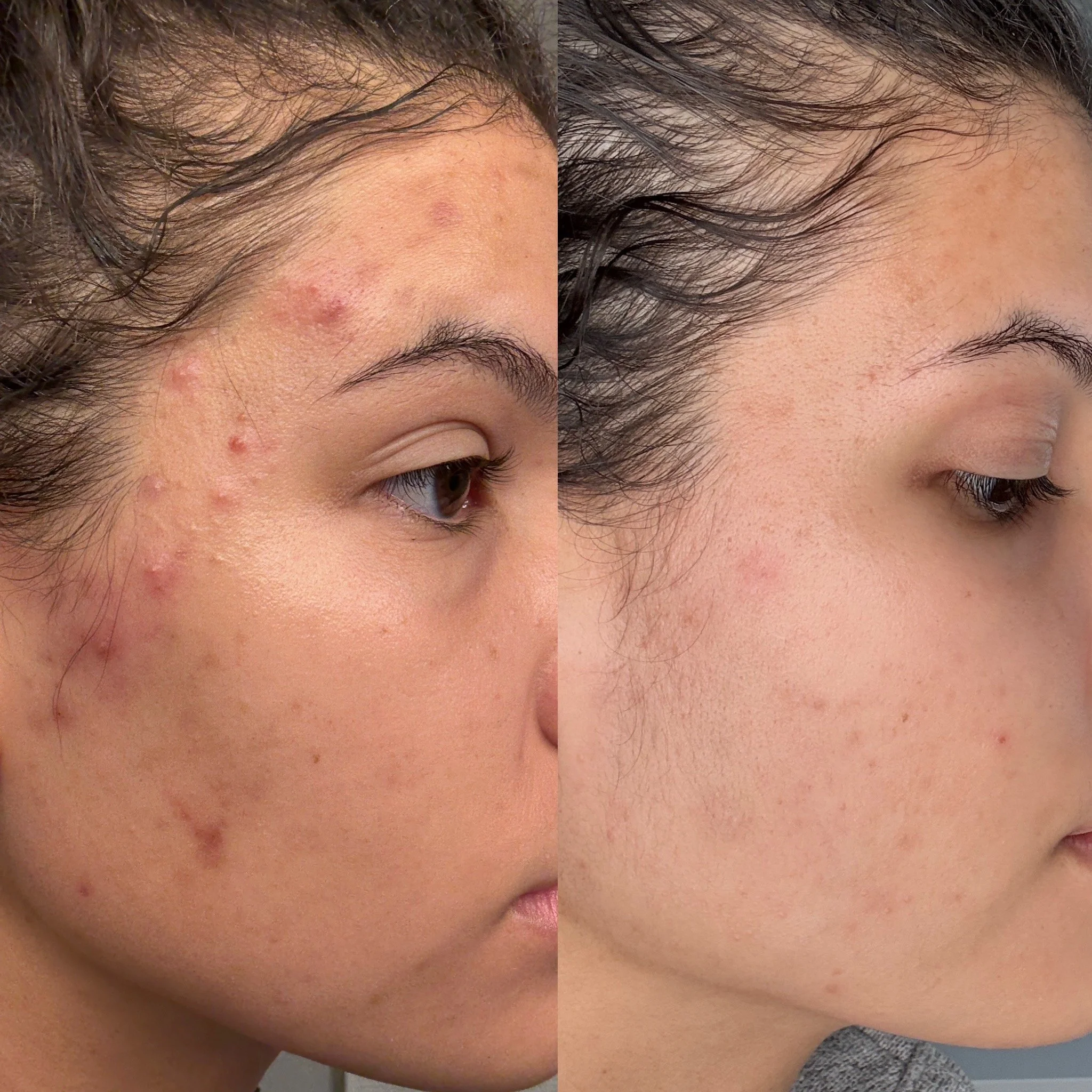 Best acne specialist Kansas City
