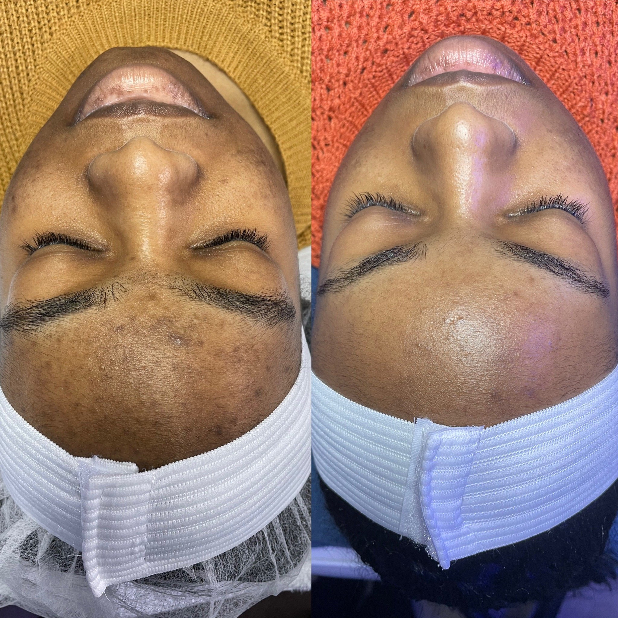 Chemical Peel Before and After: What Changes You’ll See in Your Skin