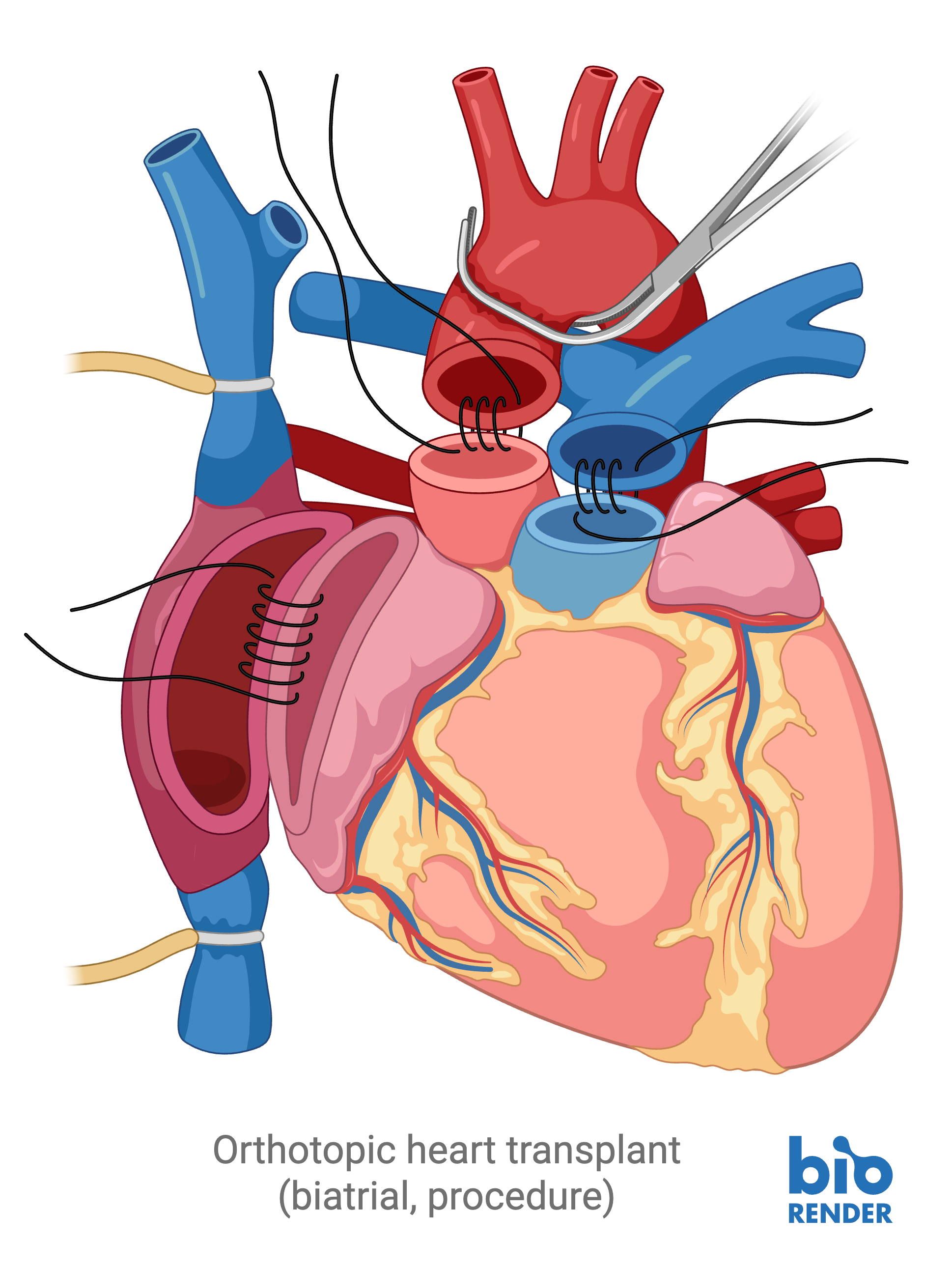 2 - heart transplant.png