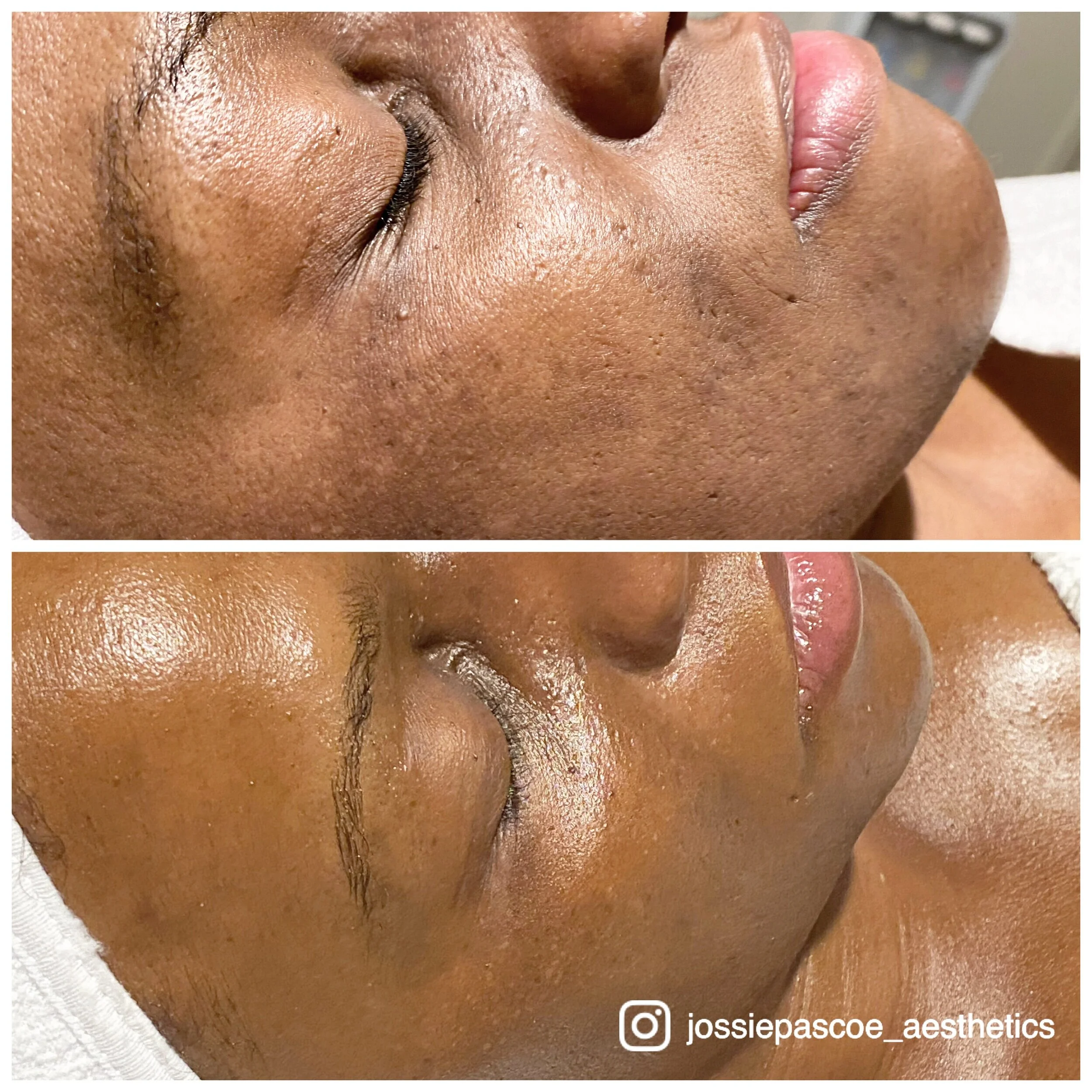 Before and after images showing skin improvement, with the second image displaying smoother and more radiant skin compared to the first.