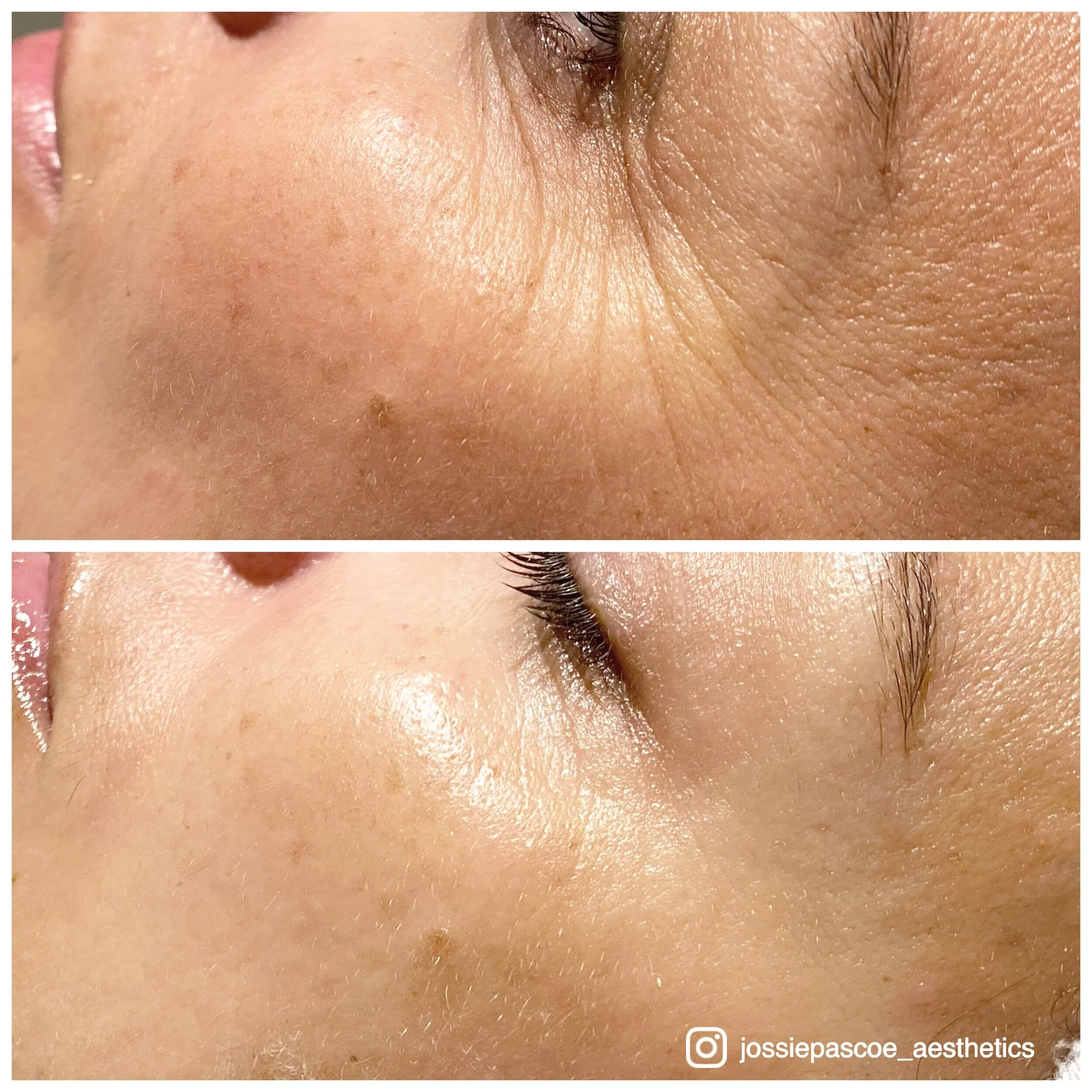 Close-up comparison of skin before and after skincare treatment, showing improved texture and reduced hyperpigmentation.