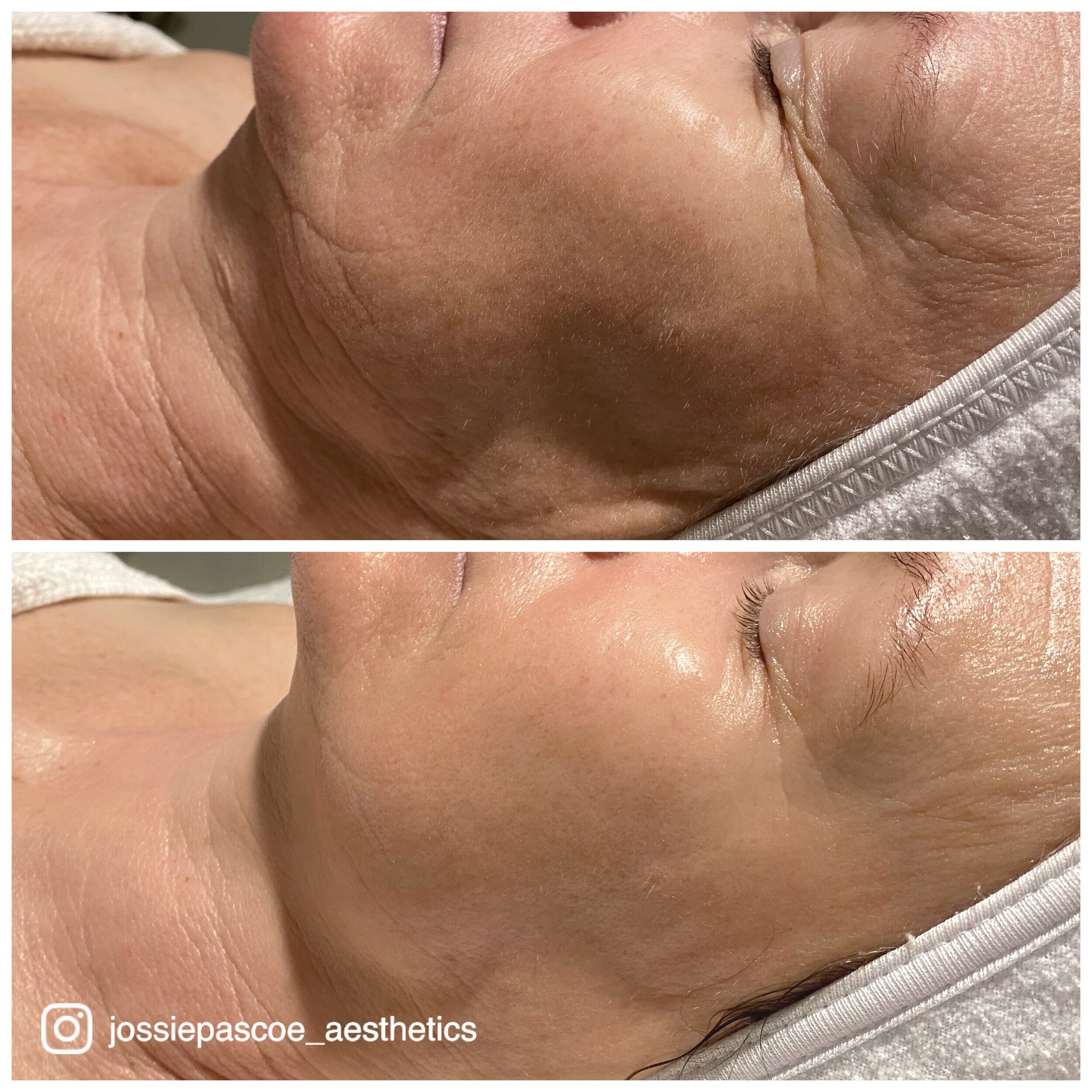 Before and after close-up images of a person's face, showing improved skin texture and appearance after skincare treatment, with the person lying down with eyes closed.