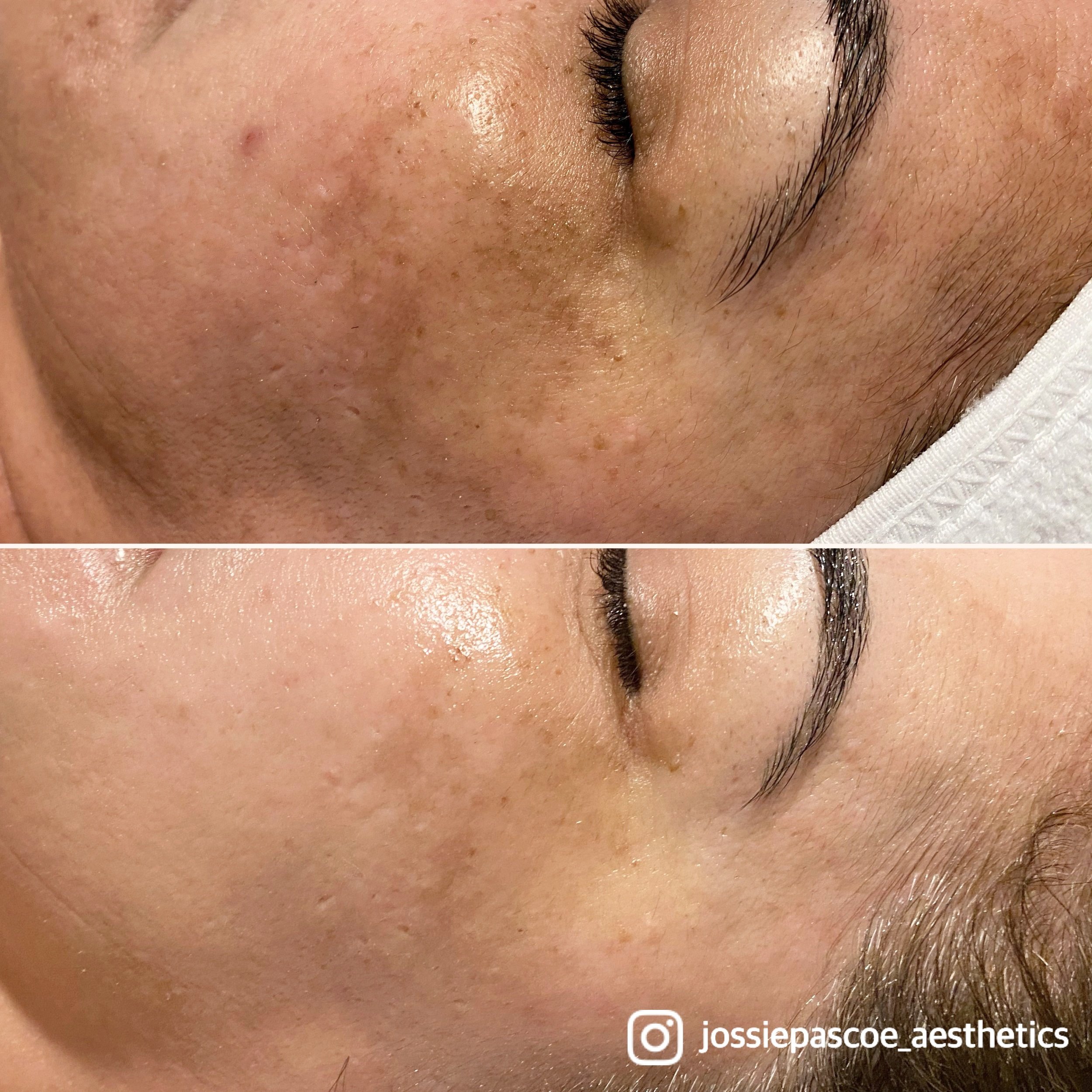 Close-up of a person's cheek and nose showing skin before and after treatment, with the after image displaying smoother and clearer skin.