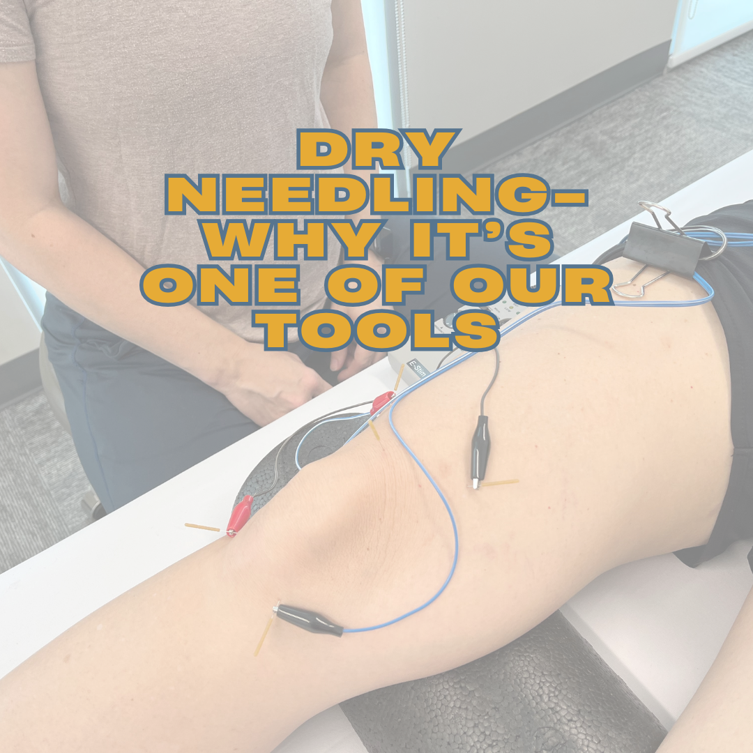 Dry Needling: What It Is, How It Works, and Why We Use It as a Tool