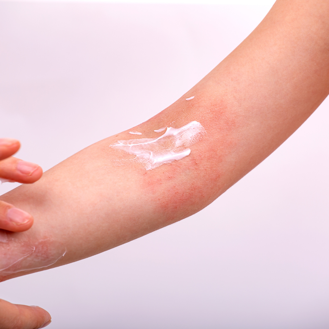 A young girl with cream on the eczema on the arm