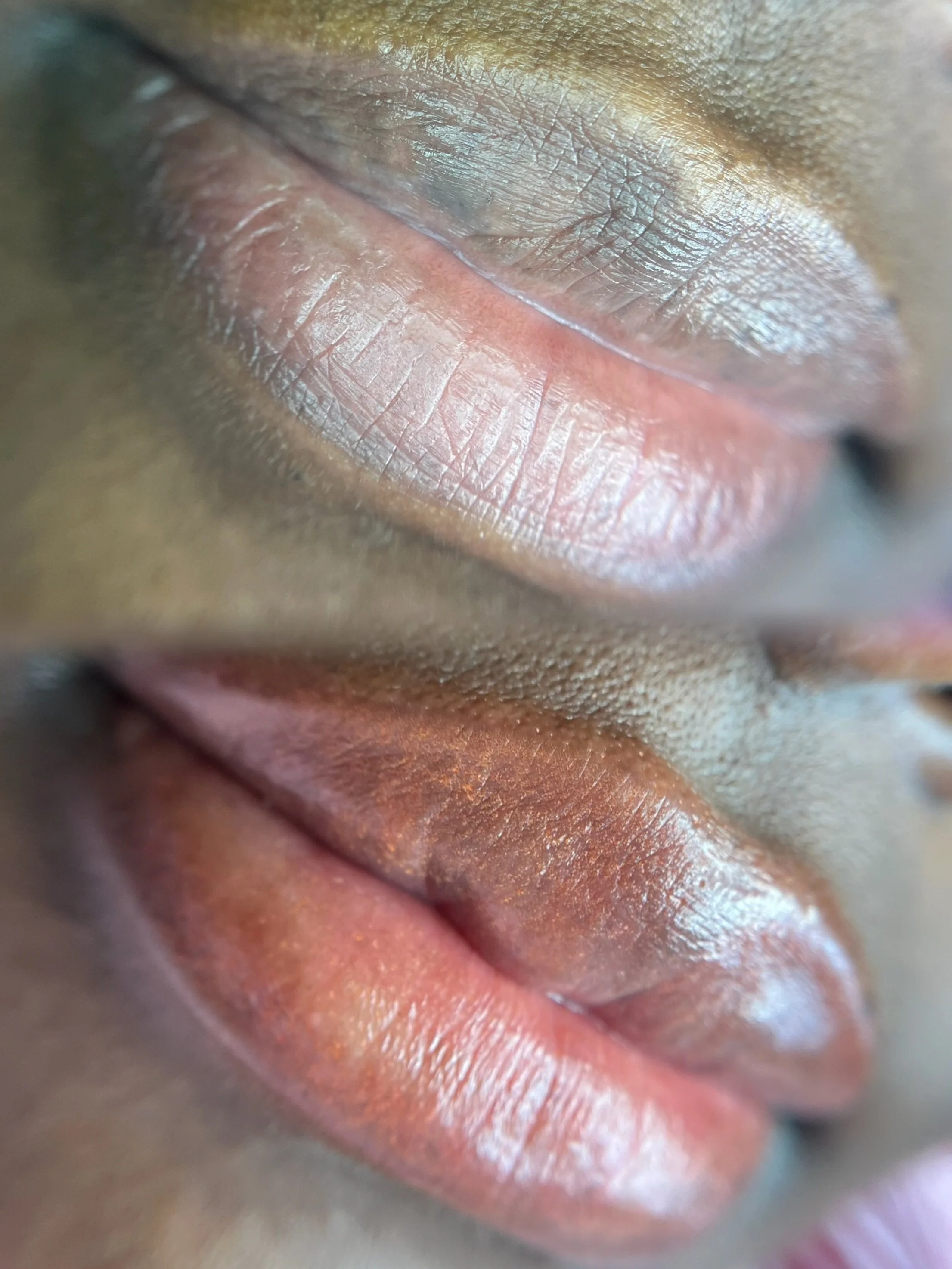 Dark lip correction dark lip neutralization