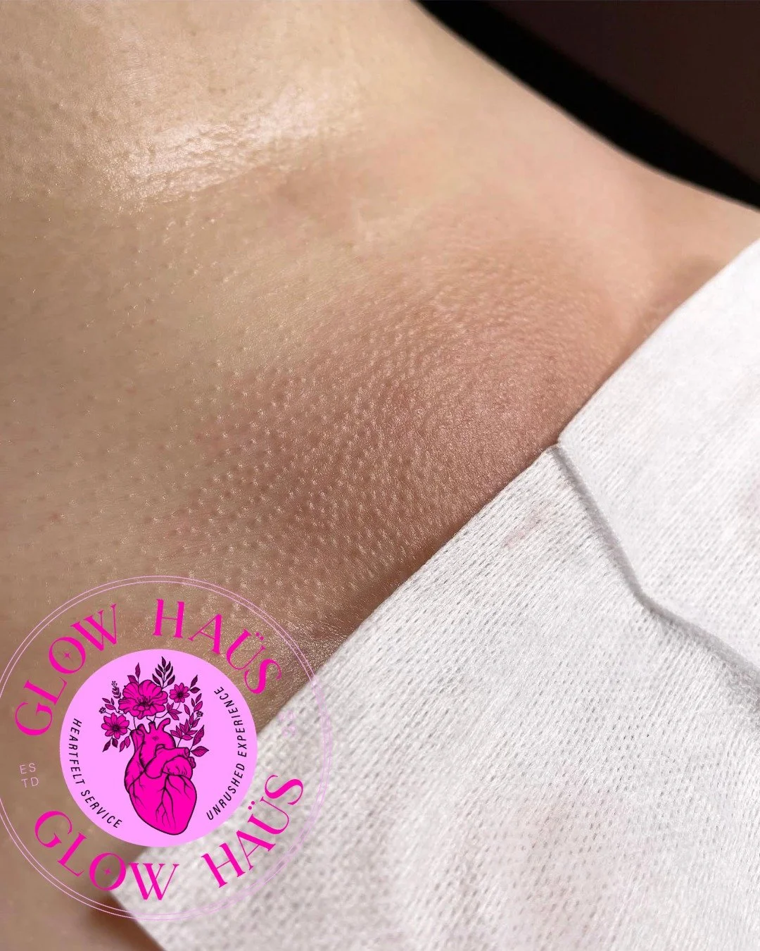 Would you believe us if we told you this was her FIRST Brazilian wax ever?! 🤩
ㅤ
She came in with about two months of hair growth, which meant we were able to remove about 99% of the hair with wax + only had to tweeze about five stubborn little hairs