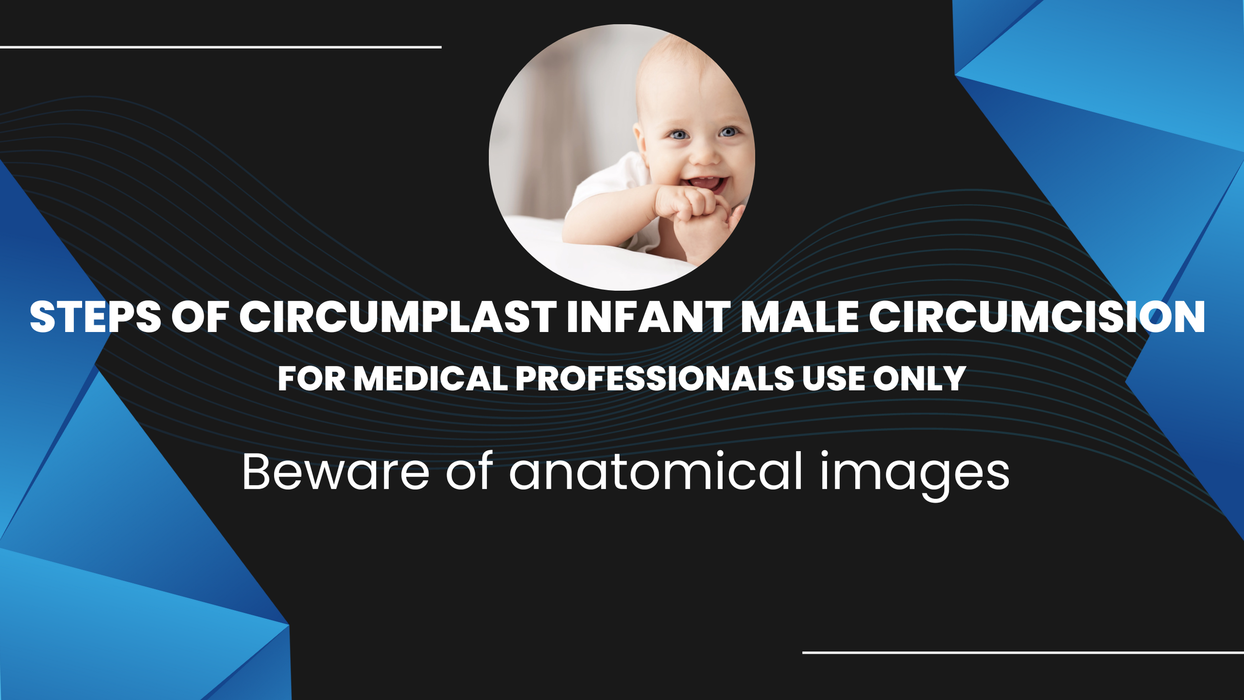 Steps of infant male circumcision by Circumplast device — Emboss Medical