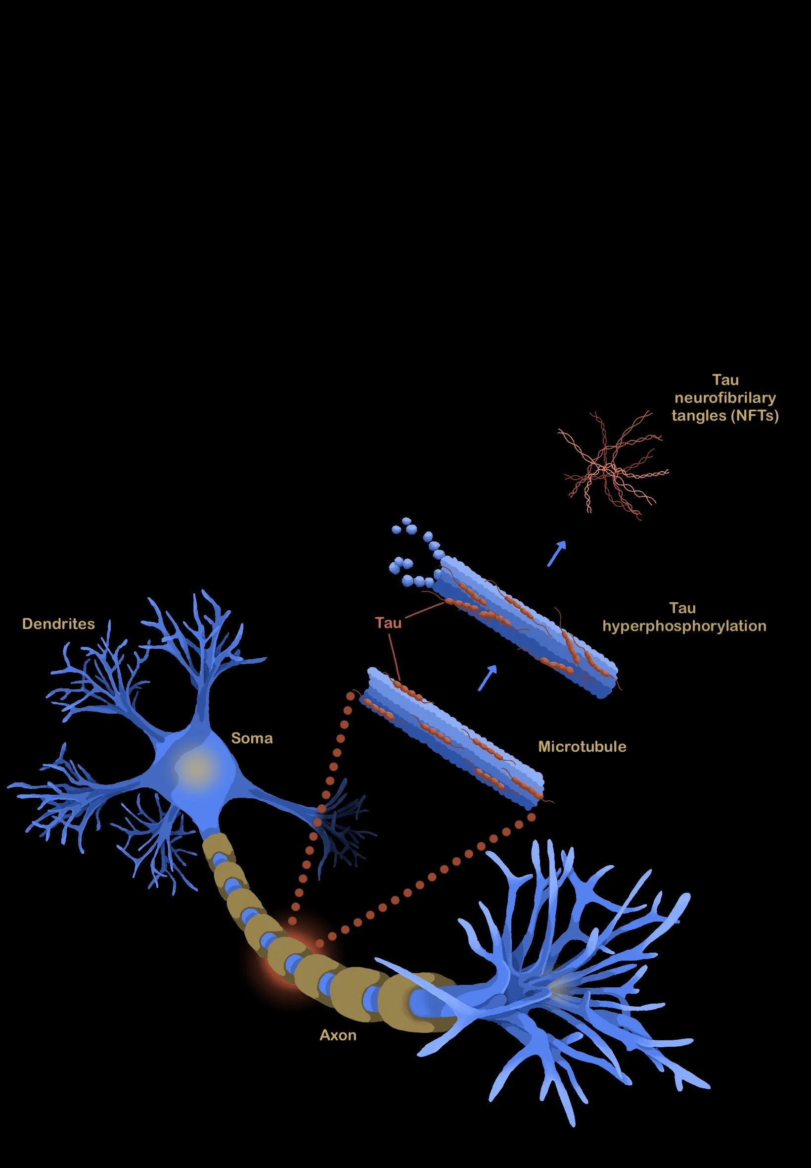 Art By: Alexandra Adsit, "Total Blitz on the Brain: The Elusive Tactics of Chronic Traumatic Encephalopathy"