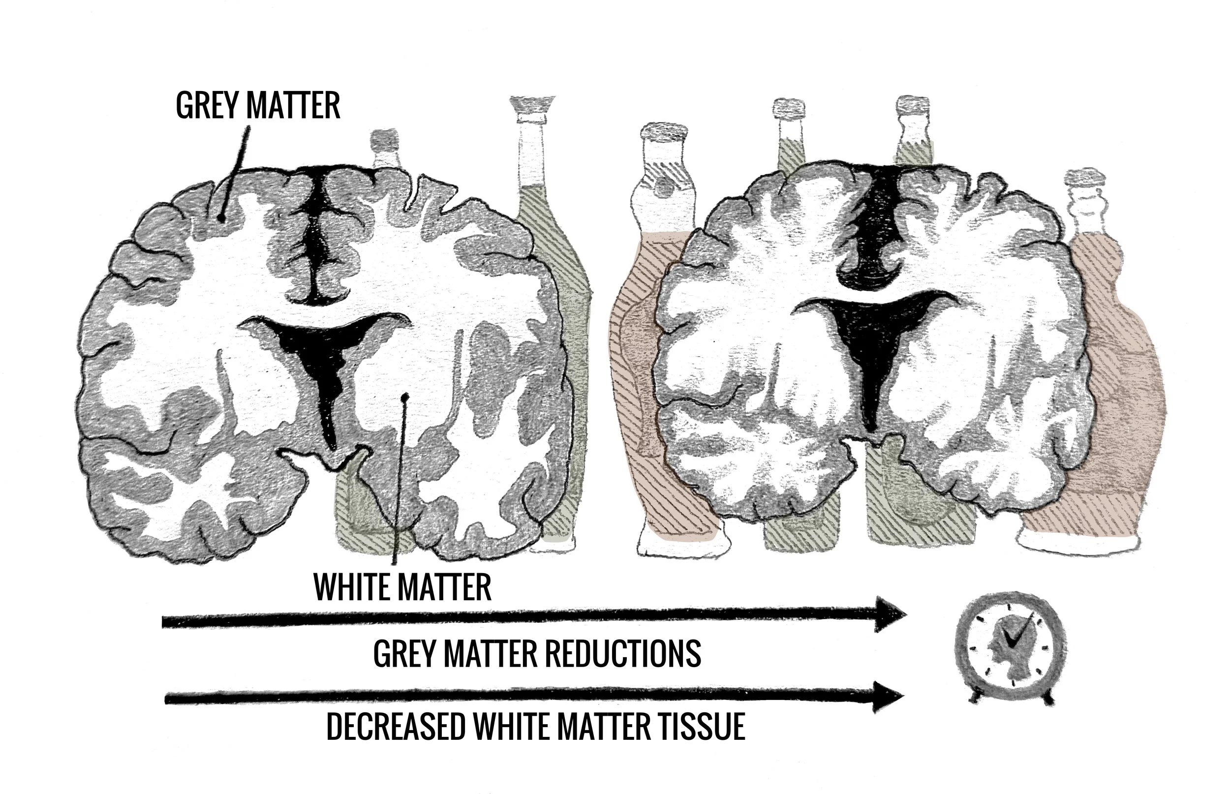 Art by Ruimei Chau, “Drinks On Me: How Alcohol Consumption Impacts Your Brain”