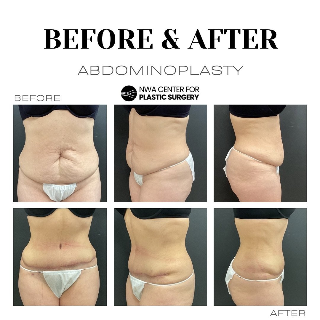WOW, look at this remarkable before-and-after abdominoplasty transformation by Dr. Stacey! An abdominoplasty, also known as a tummy tuck, is a surgical procedure designed to eliminate excess skin and fat from the abdomen, while also tightening the ab