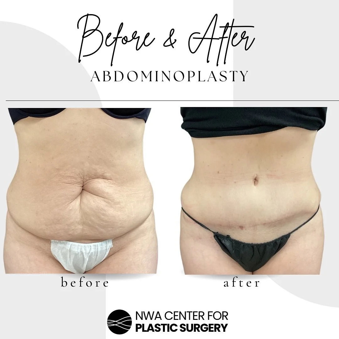 It’s Transformation Tuesday! Witness this remarkable abdominoplasty transformation by Dr. Stacey. The journey began in December 2023, with the “before” photos, and the “after” photos from November 2024 reveal just how im