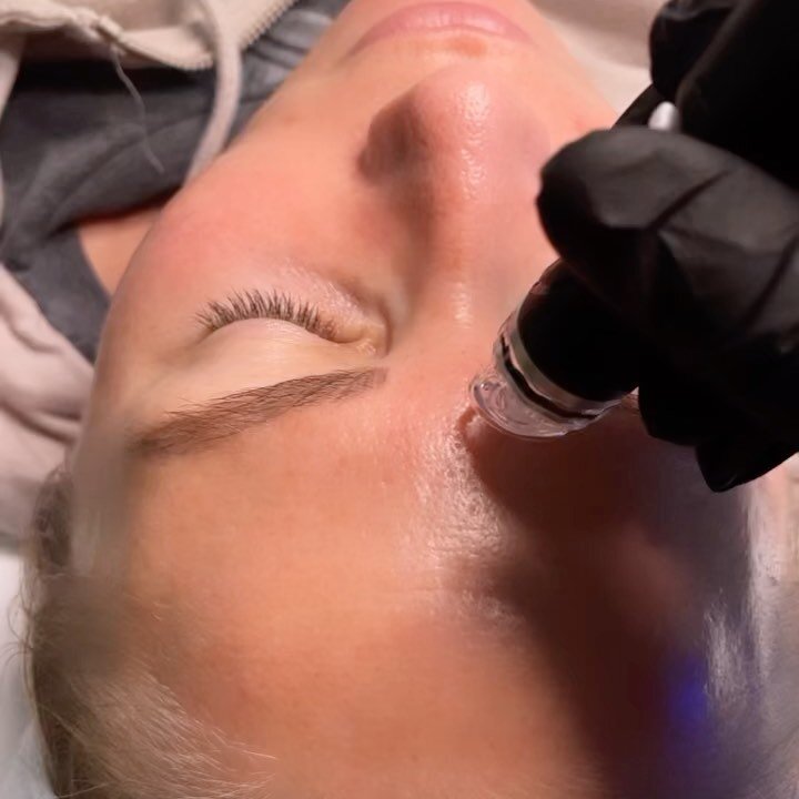 Platinum Hydrafacial 
&bull;double cleanse 
&bull;glysal prep exfoliation 
&bull;dermaplane 
&bull;extractions with beta solution to break down clogged pores 
&bull;booster chosen for your specific skin concerns 
&bull;hydrojelly mask 
&bull;LED ligh