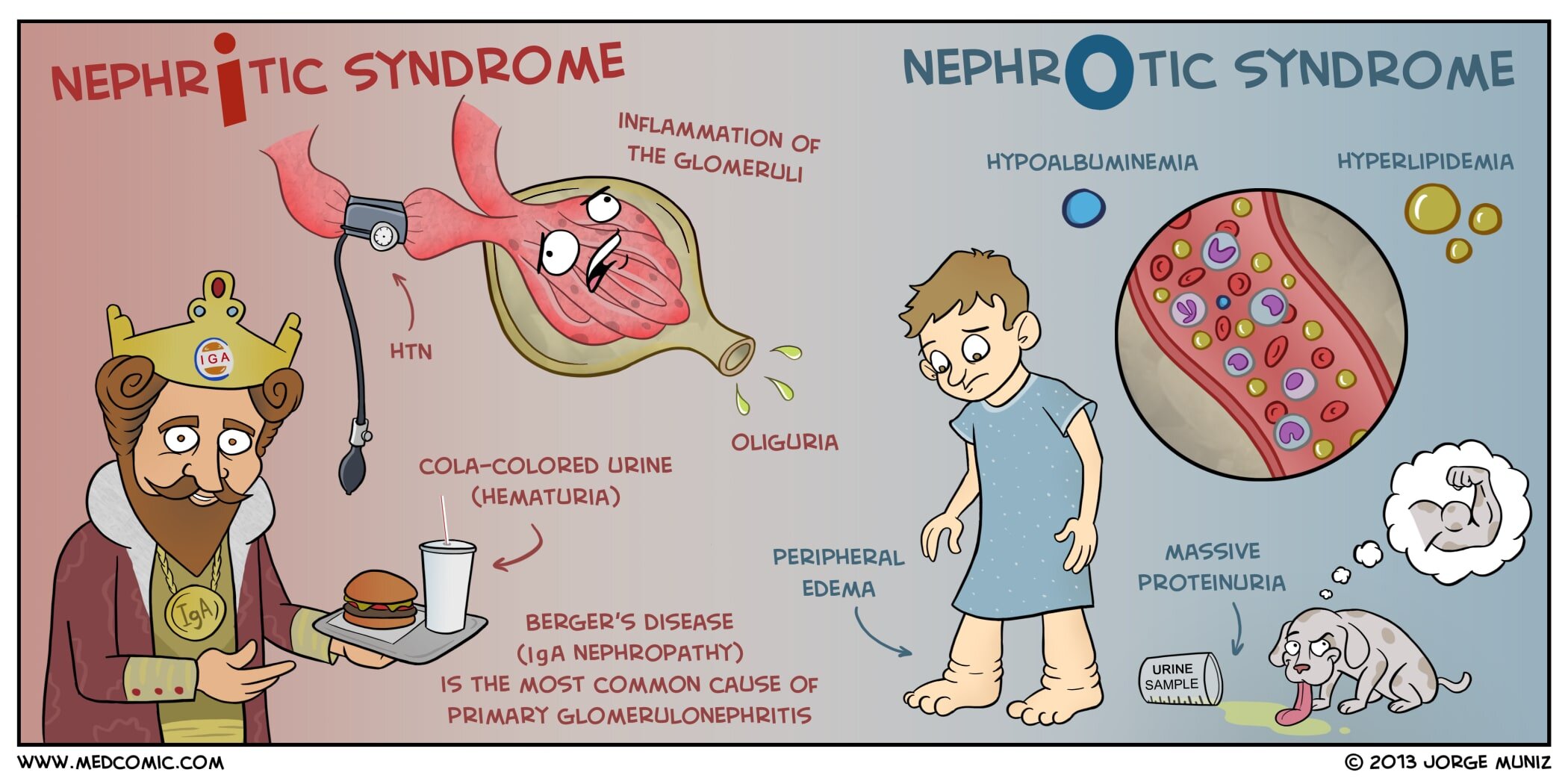 Nephrotic Syndrome Edema