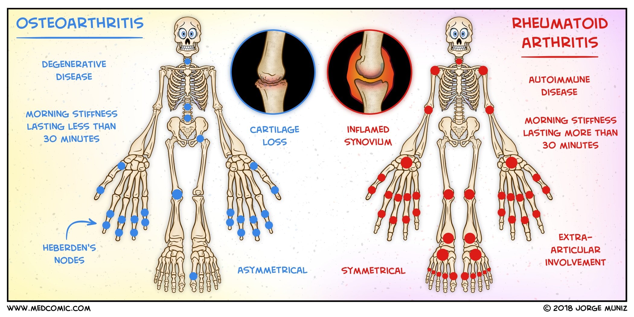 Arthritis Treatment in India | Arthritis in India