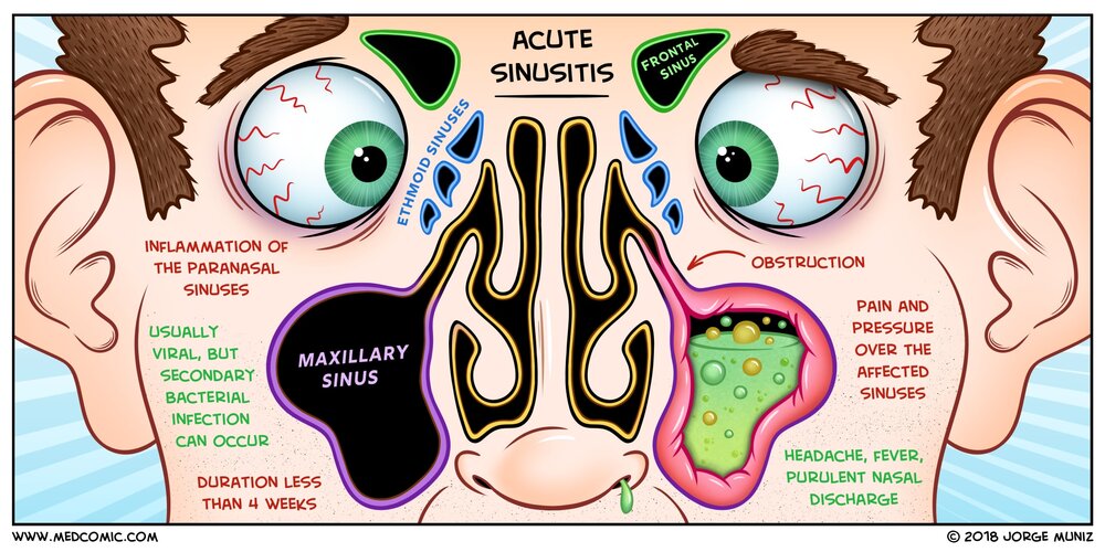 Acute Sinusitis Medcomic Acute Sinusitis Medcomic