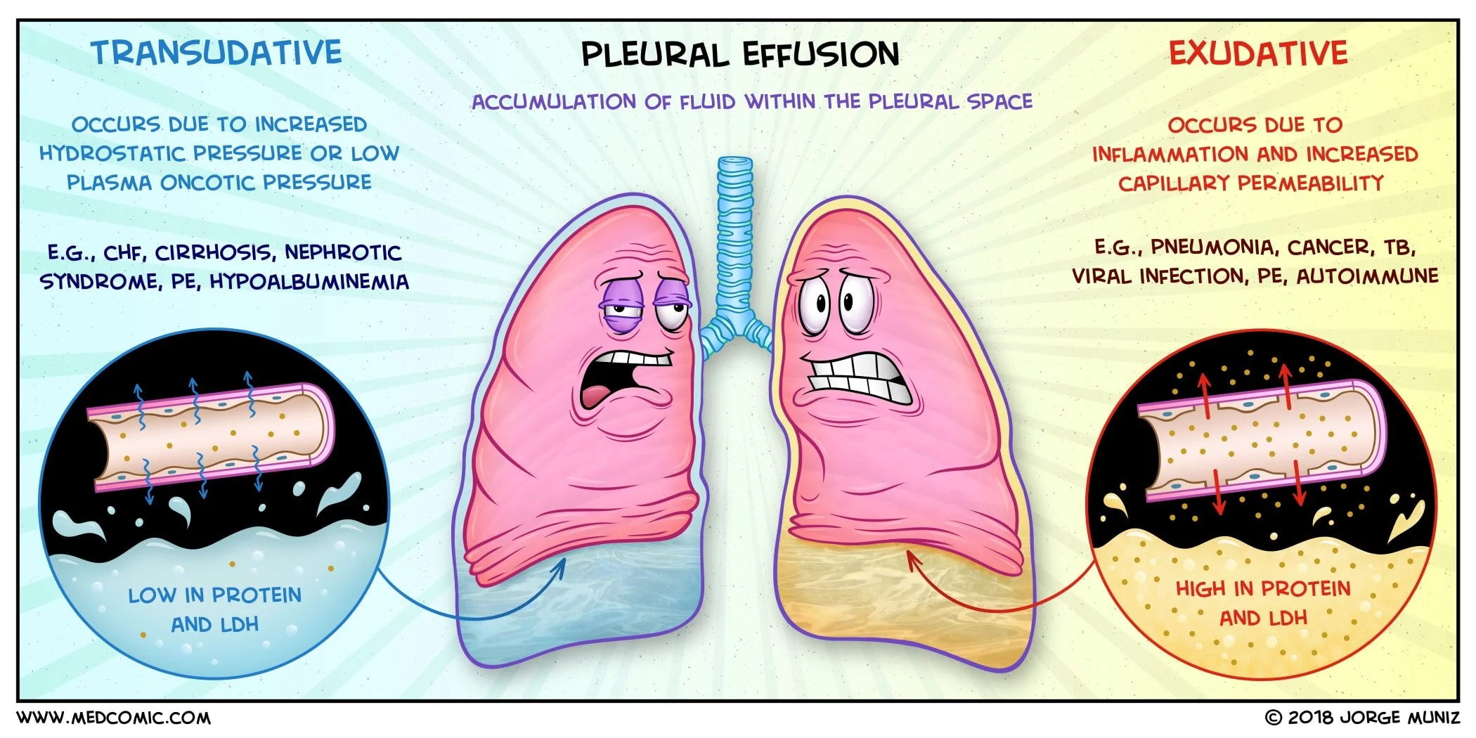 Pleural Effusions Transudate Vs Exudate MedComic