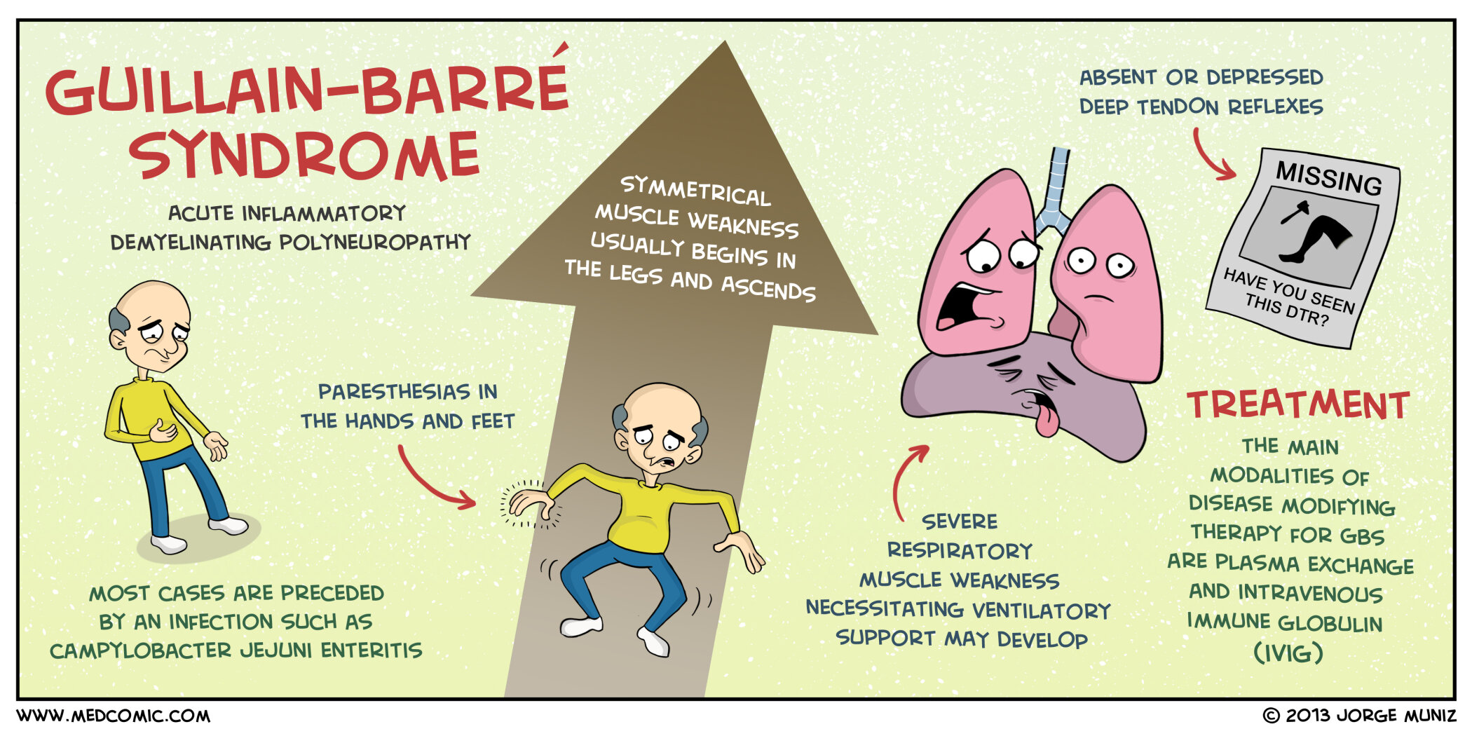 Guillain Barré Cen | Immunoglobuline intraveineuse dans le syndrome de ...