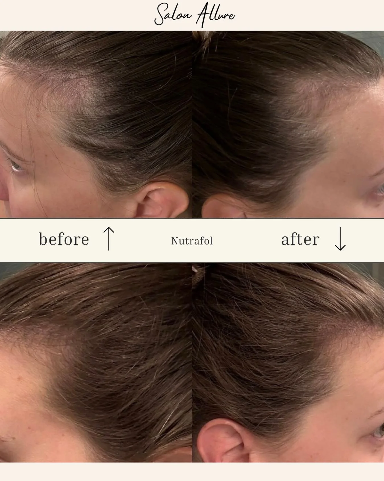 Postpartum hair loss is real, but so are results like this.
6 months of Nutrafol + patience = visible regrowth and stronger strands! Come shop Nutrafol at Salon Allure today! ✨
&bull;
&bull;
#nutrafol #huntsvillesalon #huntsville #haircare #regrowth