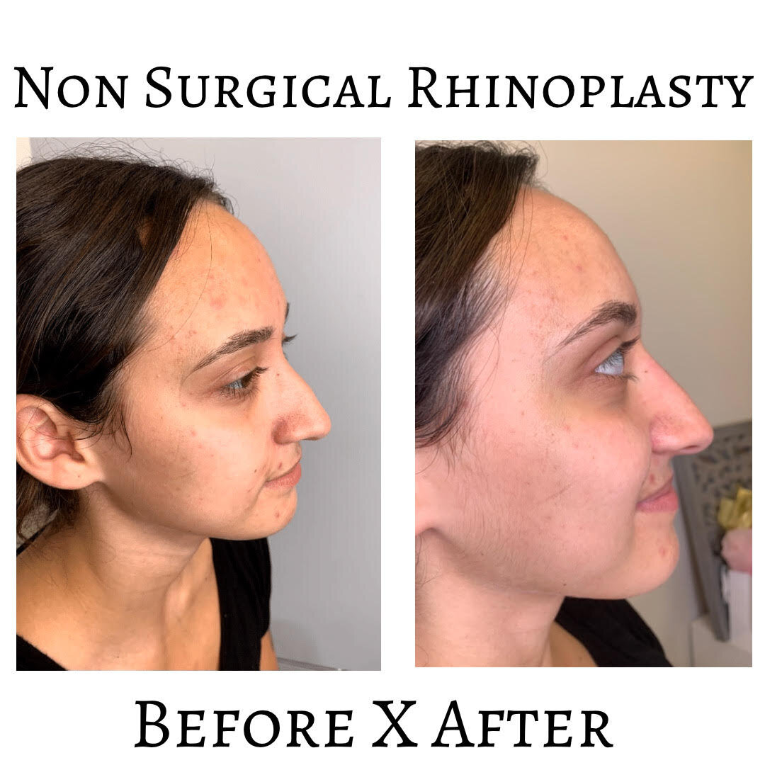 The 411 On Non Surgical Rhinoplasty