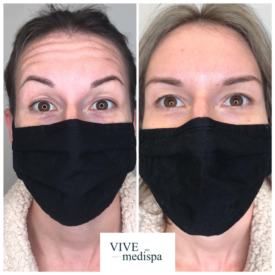 Botox Is the New Essential