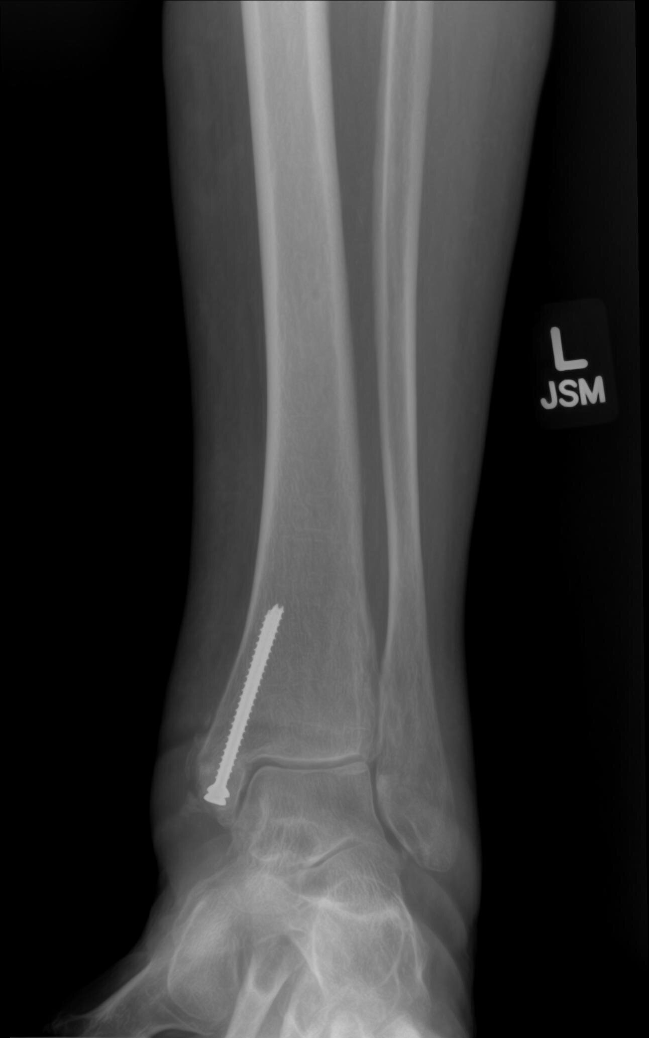 Bone Fractures — Daniel Bohl Md Midwest Orthopaedics At Rush
