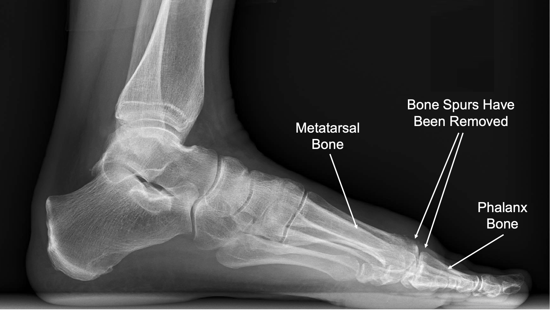 Xray Bone Spur Under Toe Bone Spur Under Achilles Tendon Clearance