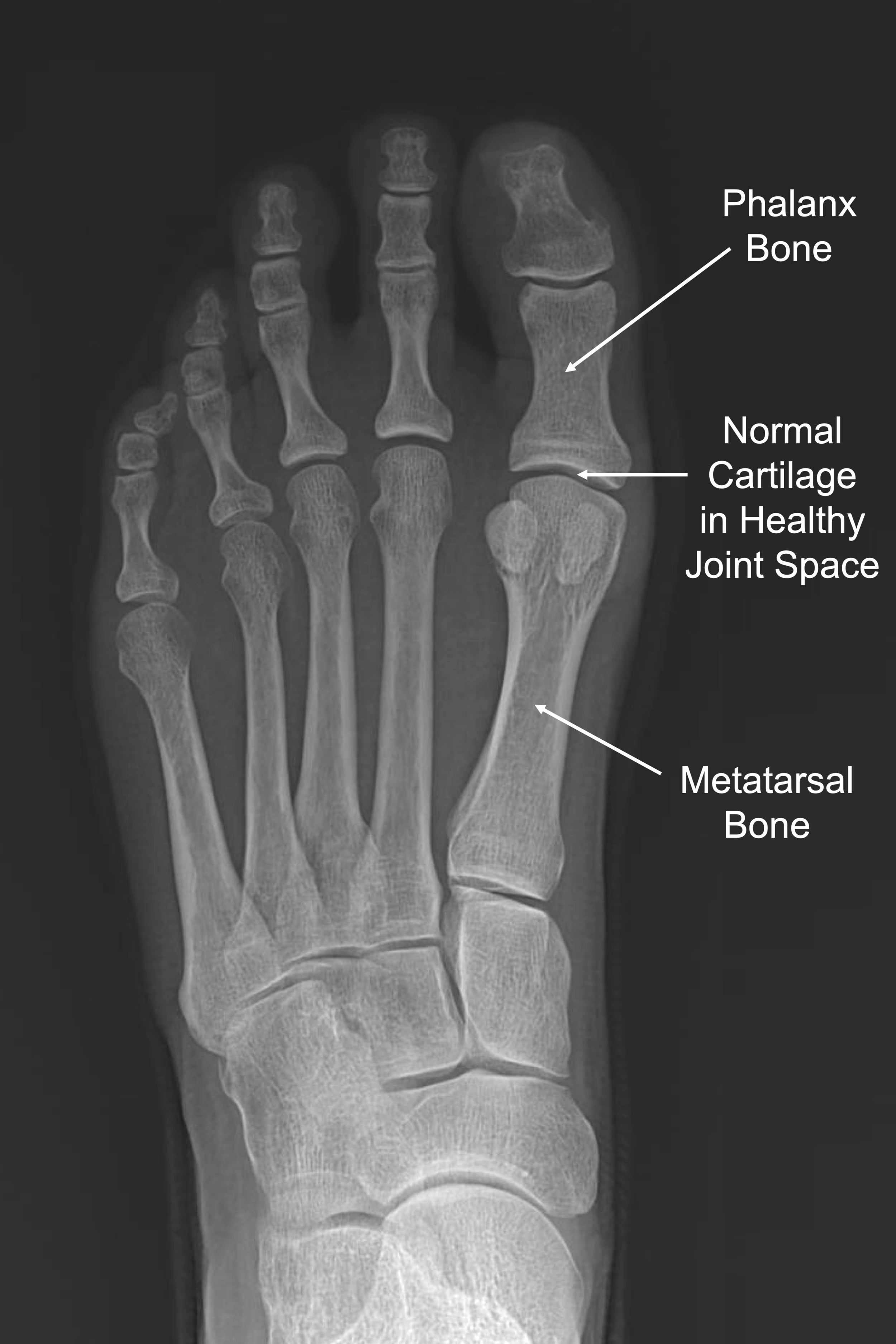 Great Toe Mtp Joint