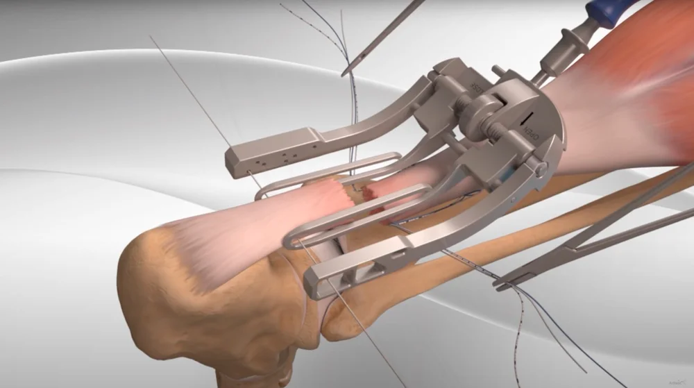 Minimally Invasive Achilles Repair  Daniel Bohl, MD | Midwest Orthopaedics  at RUSH