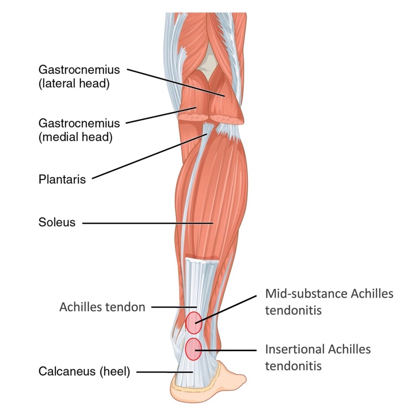 Achilles Tendonitis — Daniel Bohl, MD