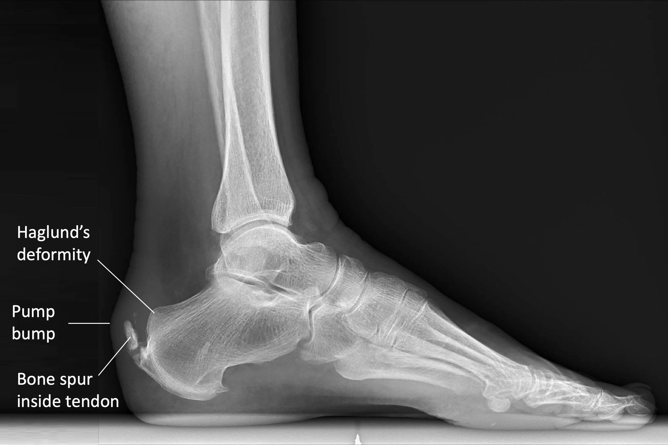Pain In The Back Of The Heel Achilles Posterior Heel Spur Pain In
