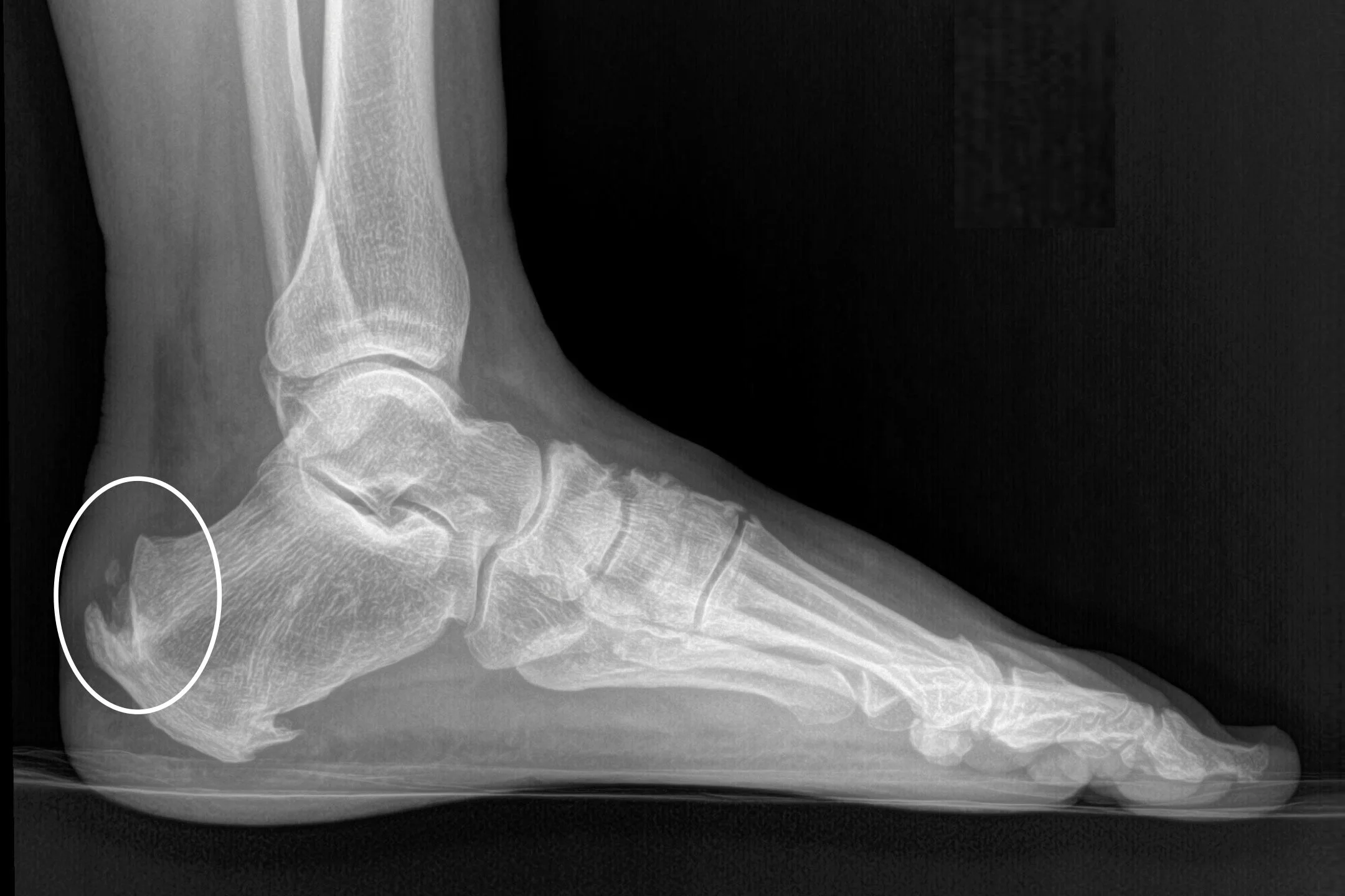Xray Heel Spur Tendinopathy Bone Spur At Achilles Insertion