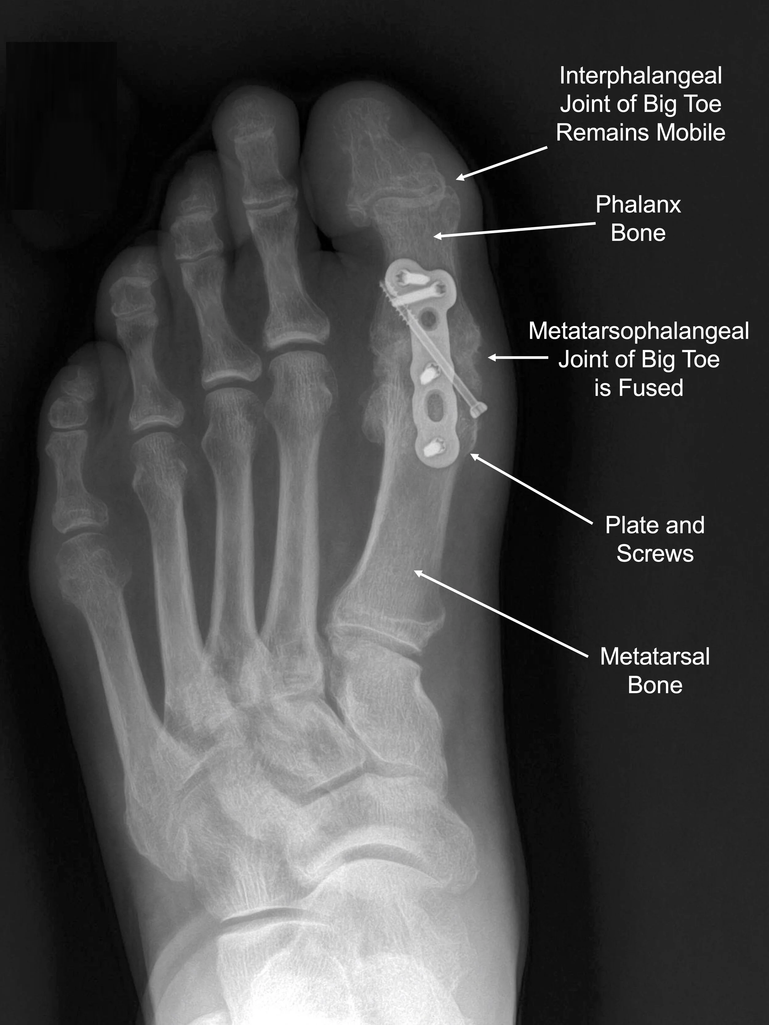 Bone growth on toe new arrivals