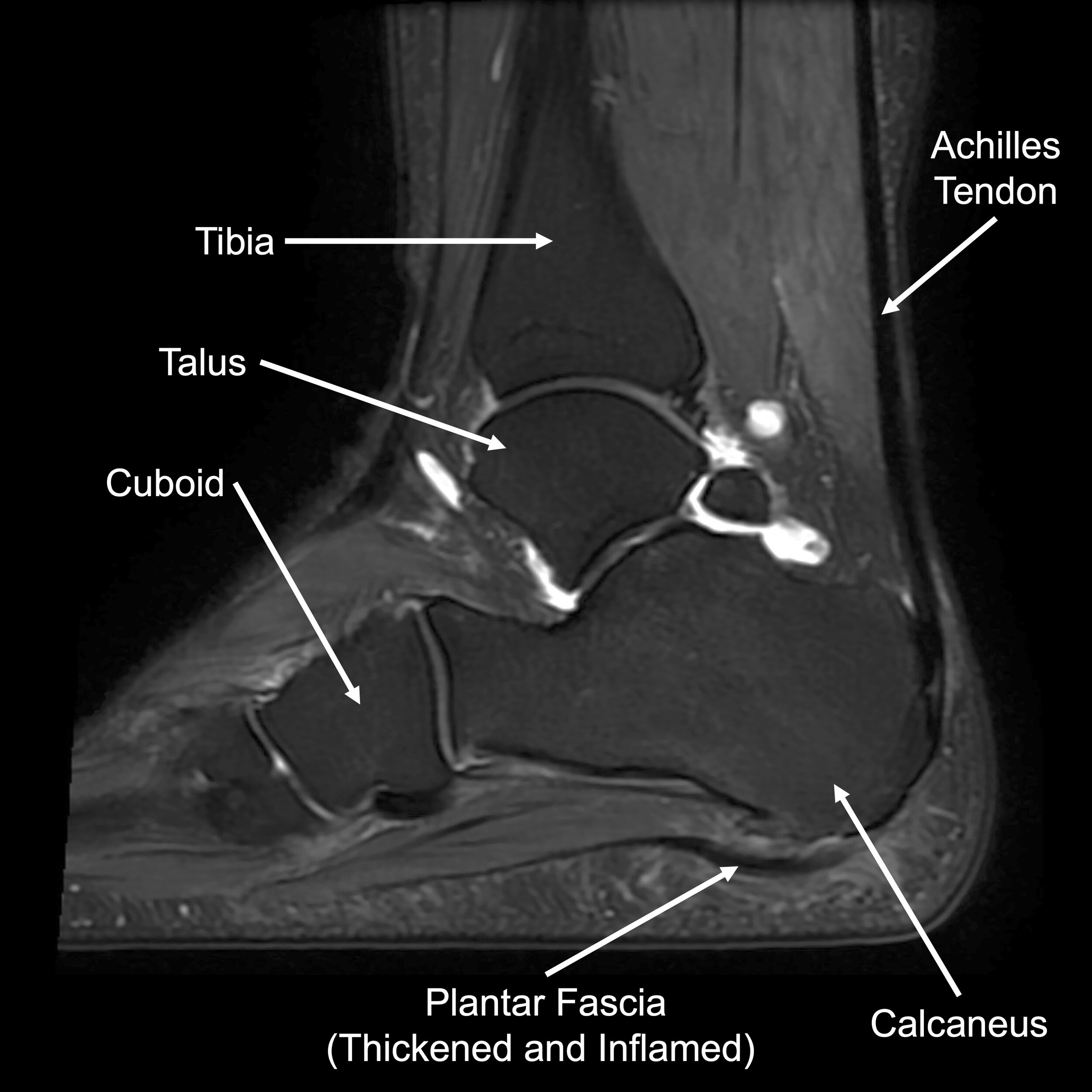 Plantar Fasciitis — Daniel Bohl, MD Midwest Orthopaedics at RUSH