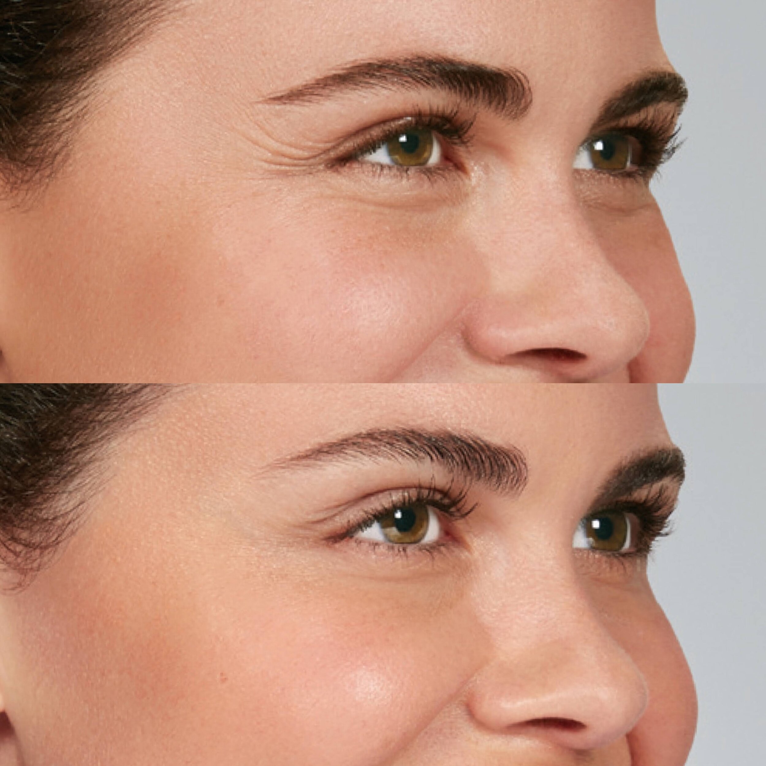 Botox crow's feet Florida treatment before and after pictures