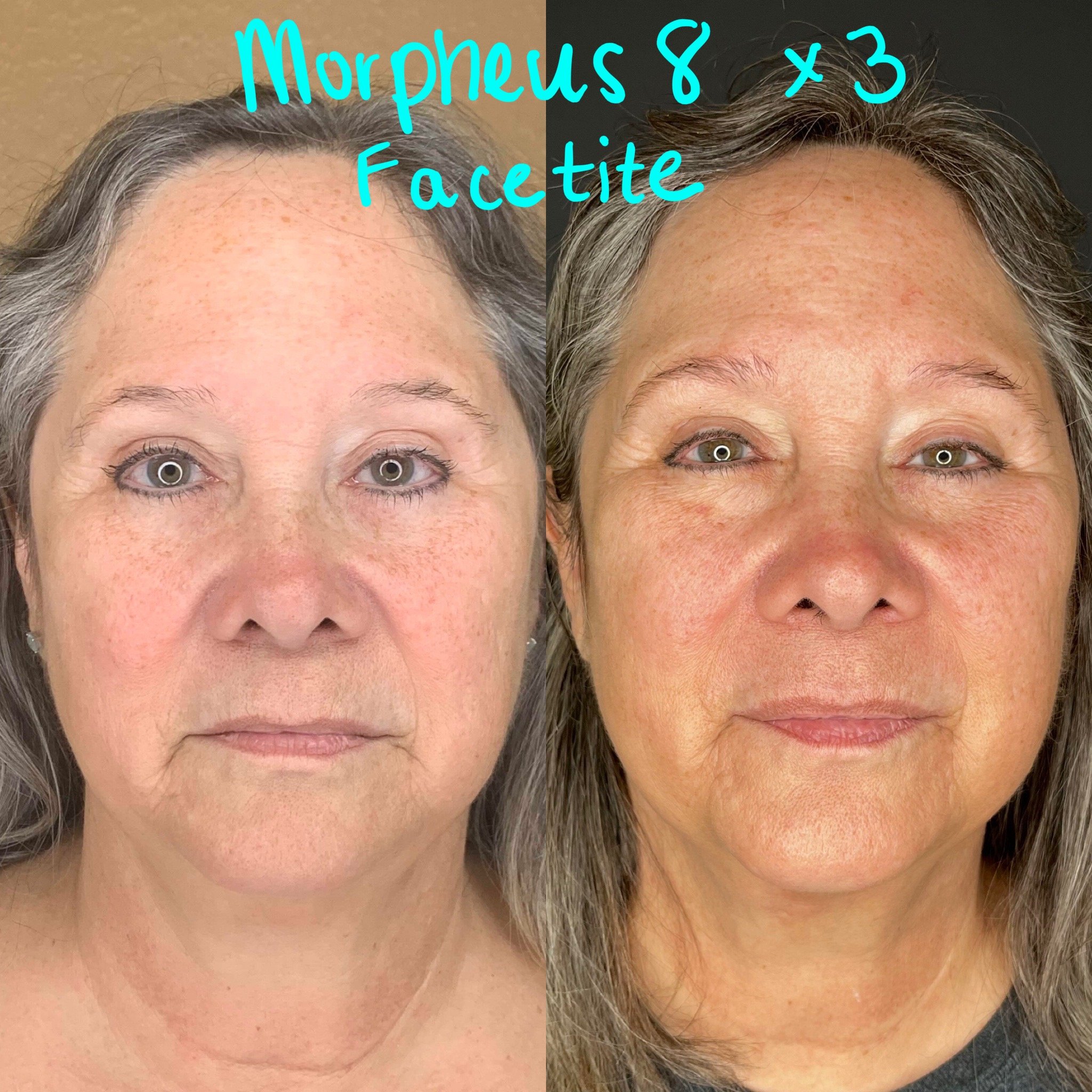 before and after mopheus8 microneedling RF therapy
