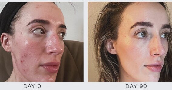 The power of @osmosis_beauty medical skincare + wellness line 
Results in just 30-90 days. A holistic (whole body) medical approach. 

#sandiegofacials #osmosisbeautysandiego #sandiegoosmosisskincare #sandiegoskinspecialist