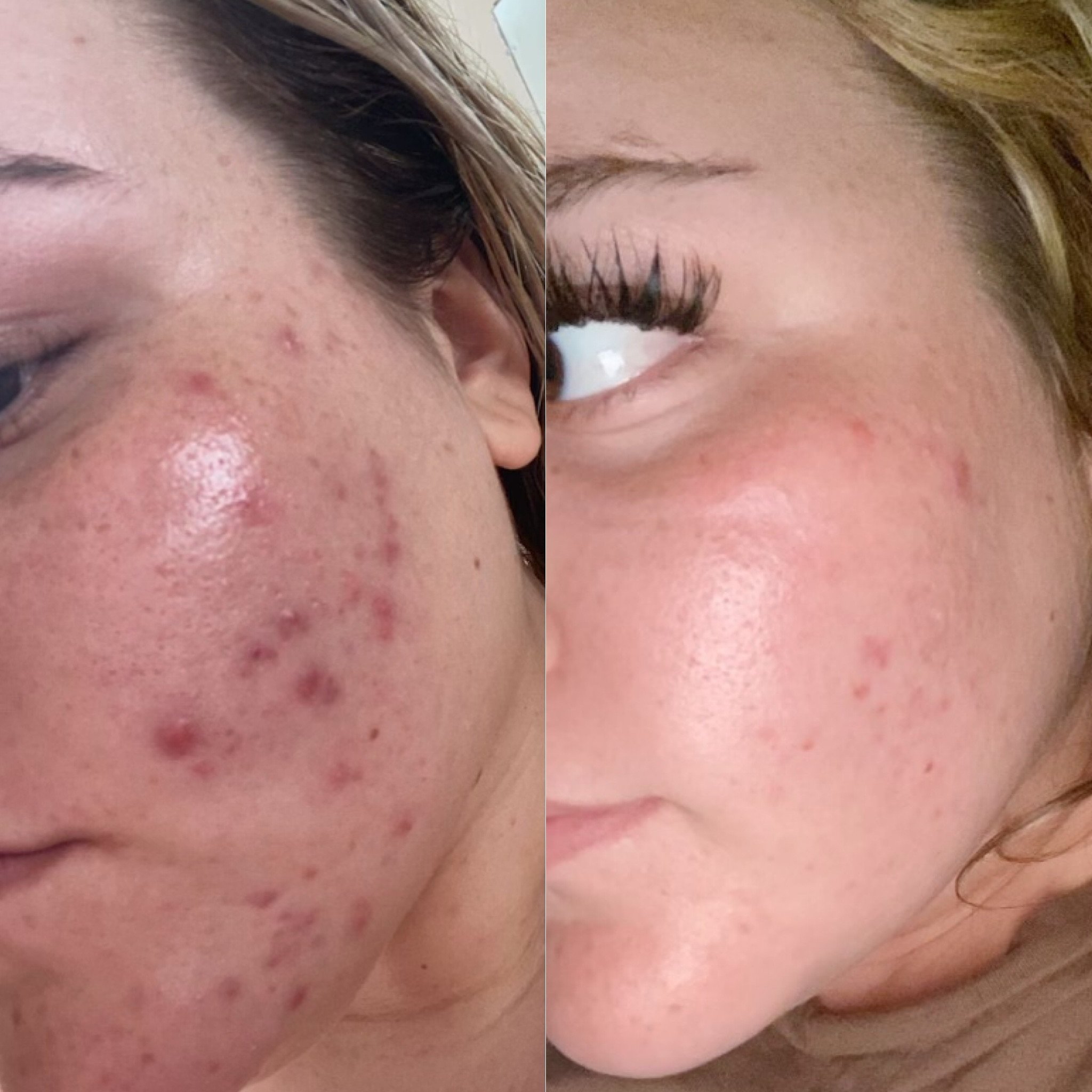 Treating acne isn&rsquo;t hard. Treating acne by yourself IS HARD. Get clear skin in 3-4 months guaranteed with unfiltered self. We use the #1 professional acne brand @facerealityskincare and see over a 95% success rate. Book a consultation or your f