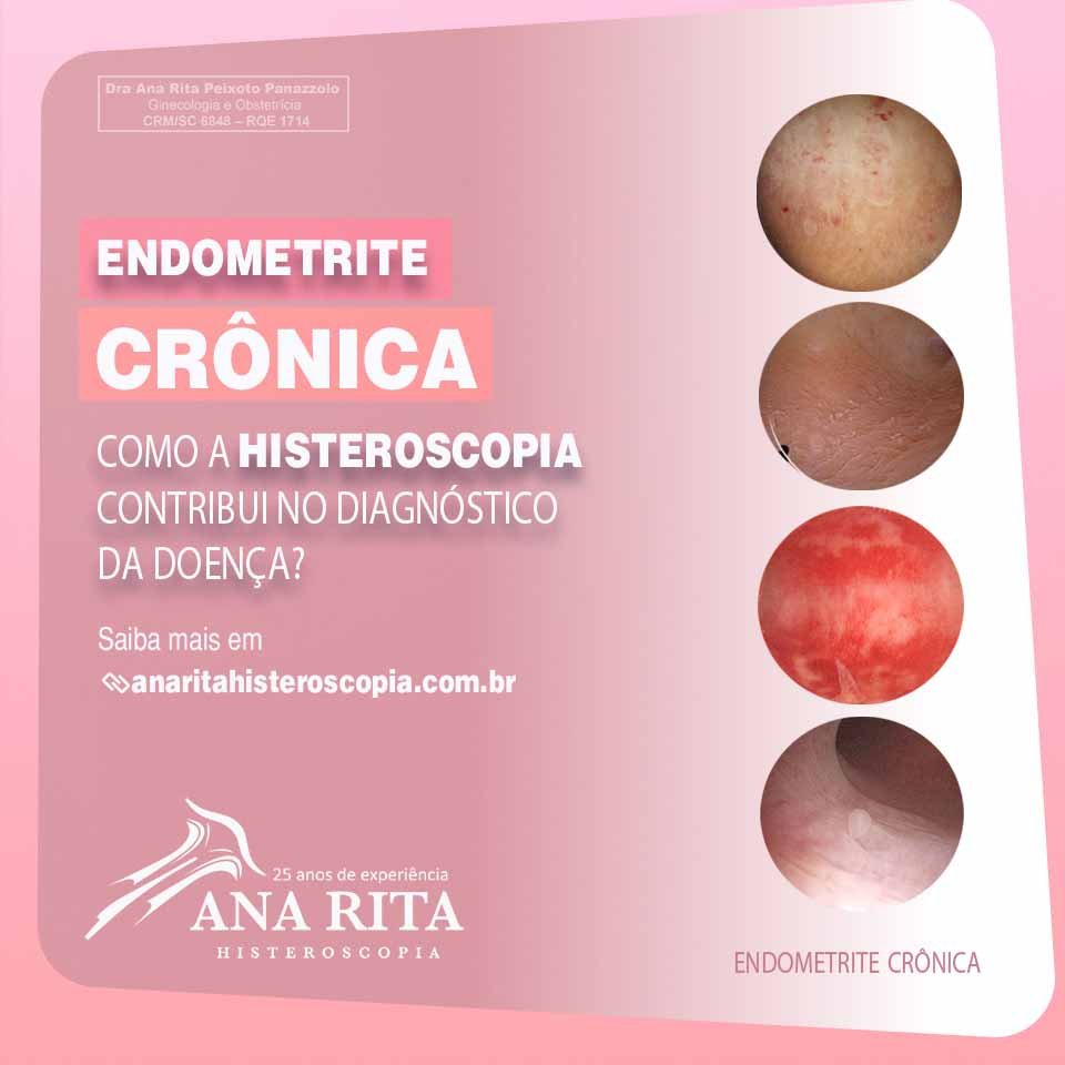 Endometrite: o que é?