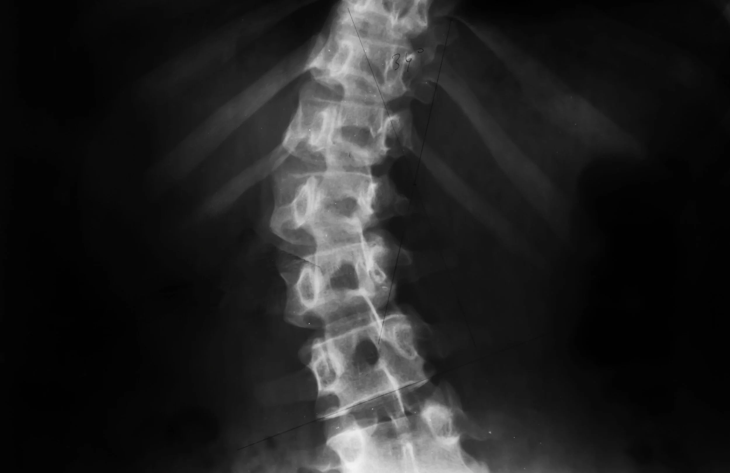 Scoliosis and the Benefits of Chiropractic Care