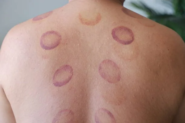 cupping marks