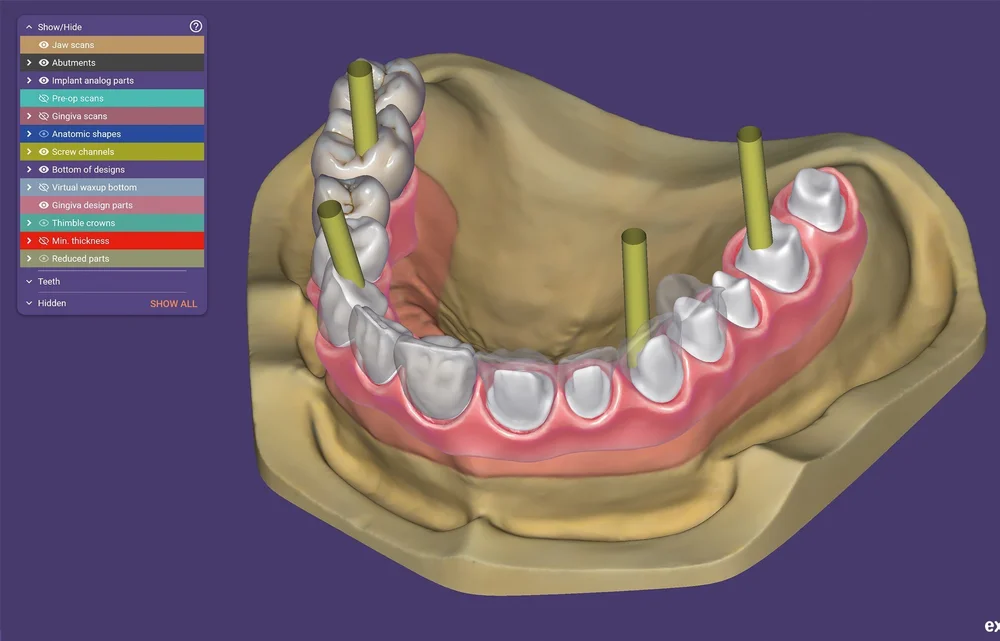 Dental CAD CAM Designs for Labs and Dentists