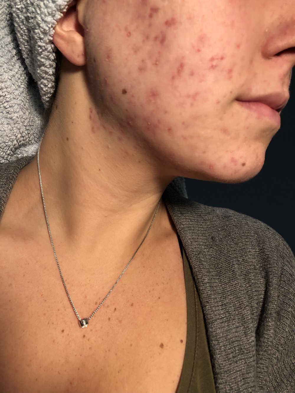 acne before.jpg