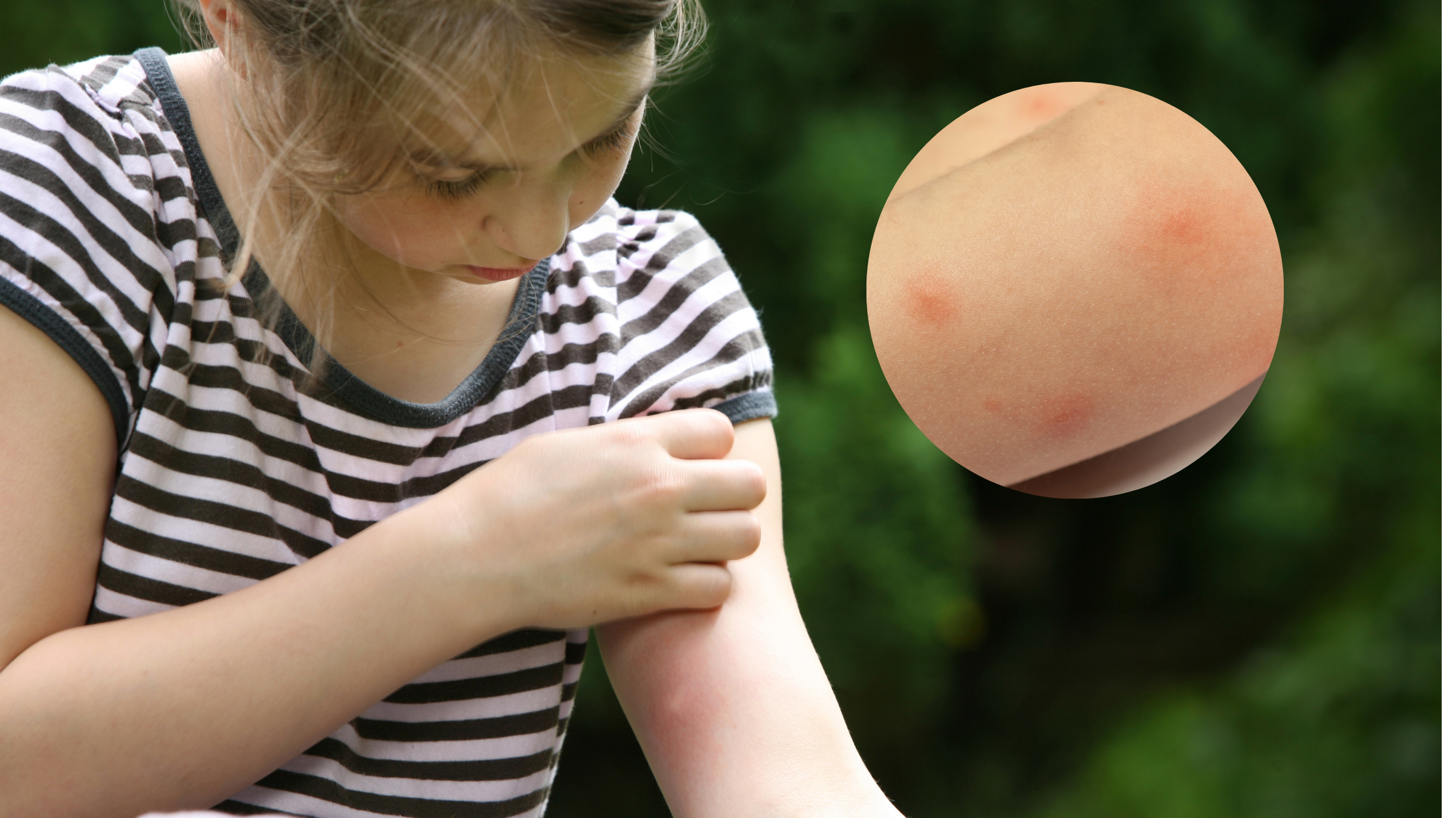 Mosquito Bite Reactions in Kids