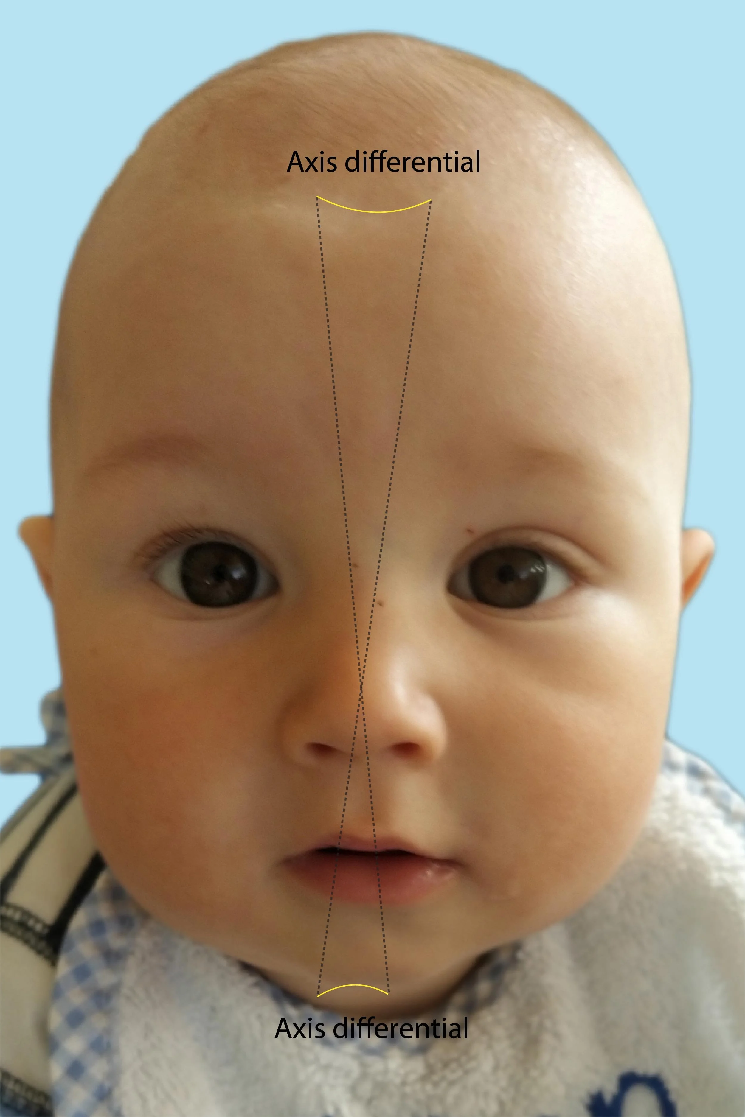 7 - Any Anomalous Features Discovered (Jaw issues, vectors, C-curves, atypical birth-caused shapes, etc.)