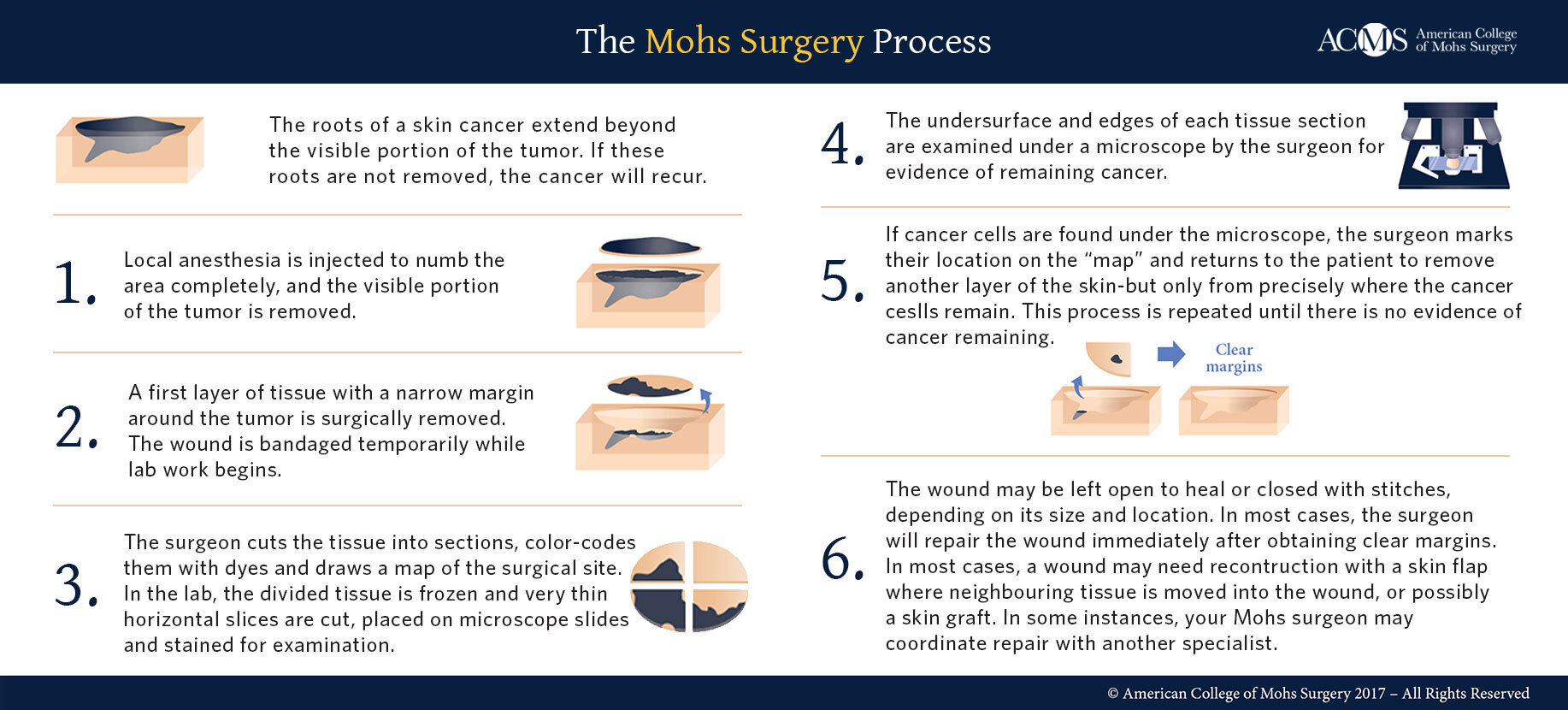 MOHS Micrographic Surgery — SkinMed Institute - Mona Sadeghpour MD &  Sabrina Newman MD - Medical, Surgical & Cosmetic Dermatology - Lone Tree  Denver, Colorado