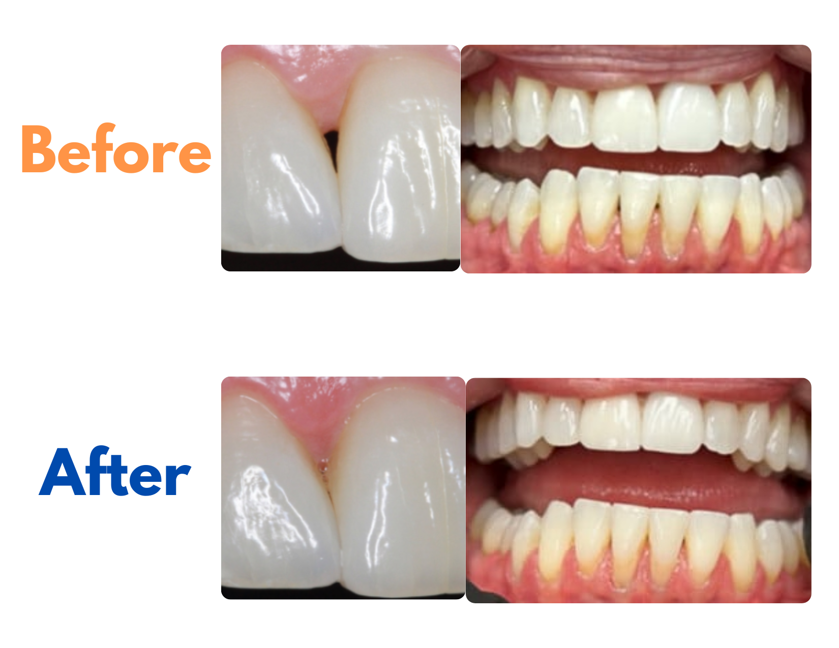 Black Triangles &amp; Gum Recession: What They Are—and the Modern, Non-Surgical Treatment Available at 7 to 7 Dental TPC