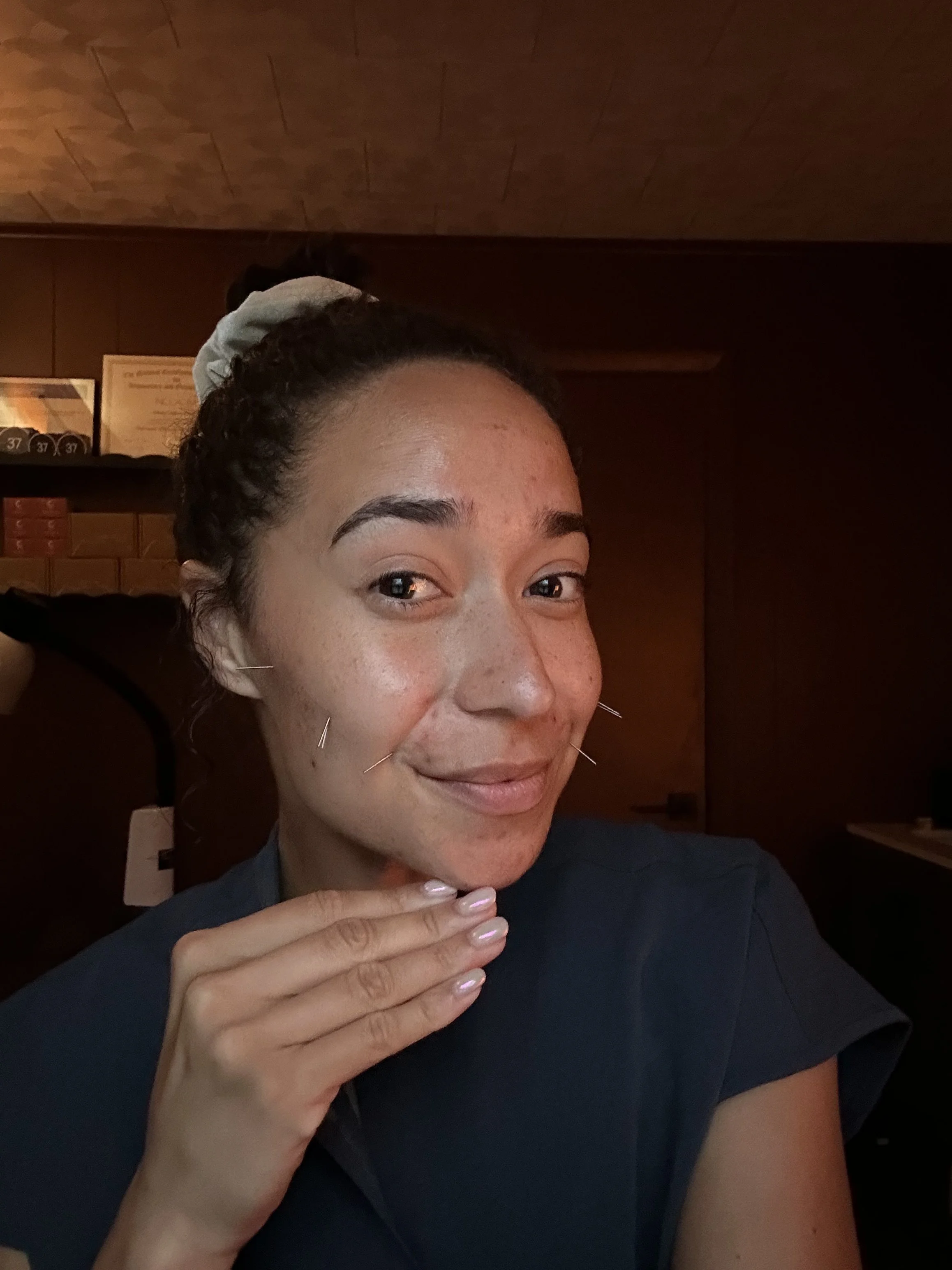 Worcester acupuncturist demonstrates cosmetic acupuncture treatment with needles placed on the face for skin rejuvenation and anti-aging.