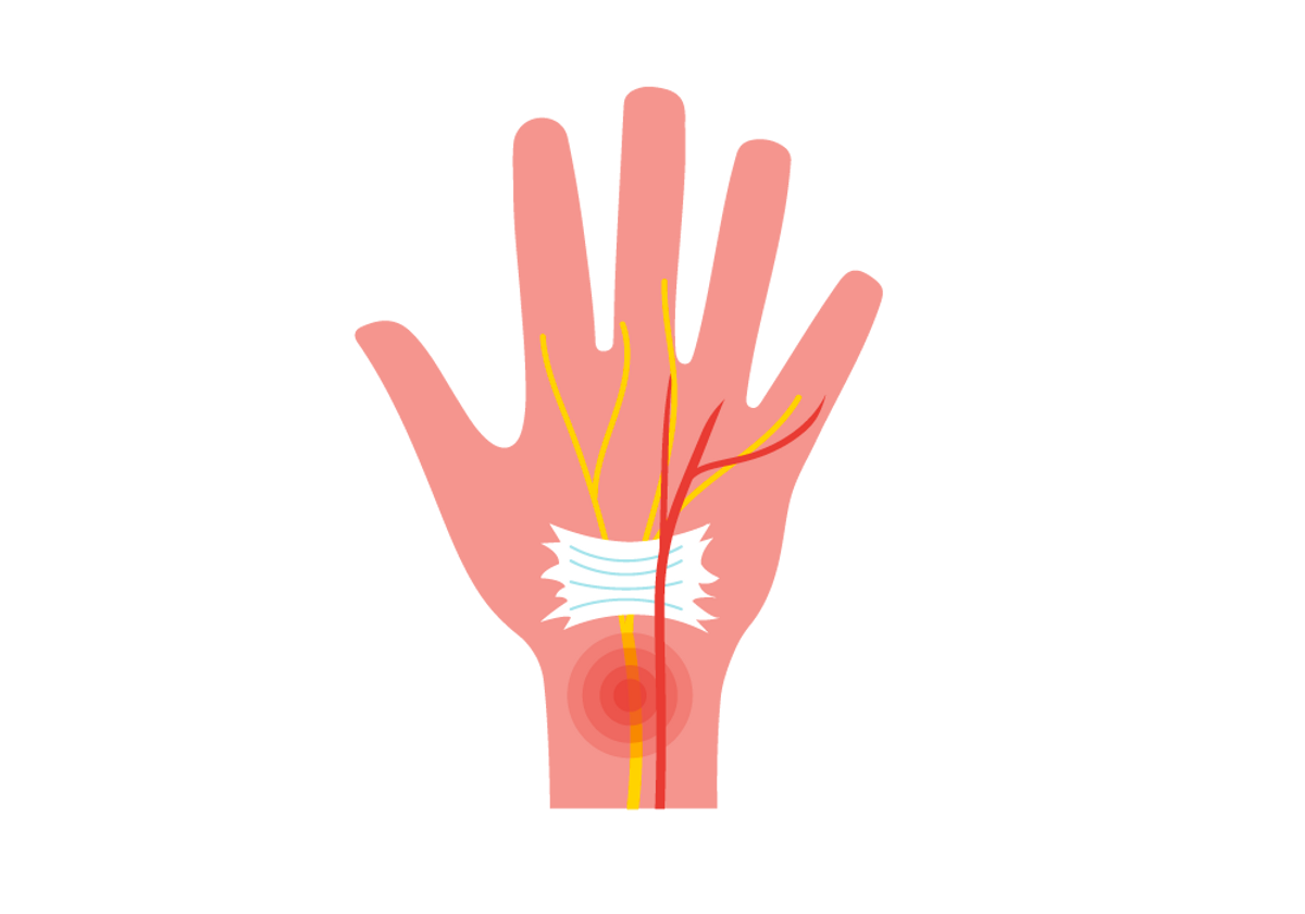 Wrist Pain, Numbness or Tingling? When It Could Be Carpal Tunnel Syndrome